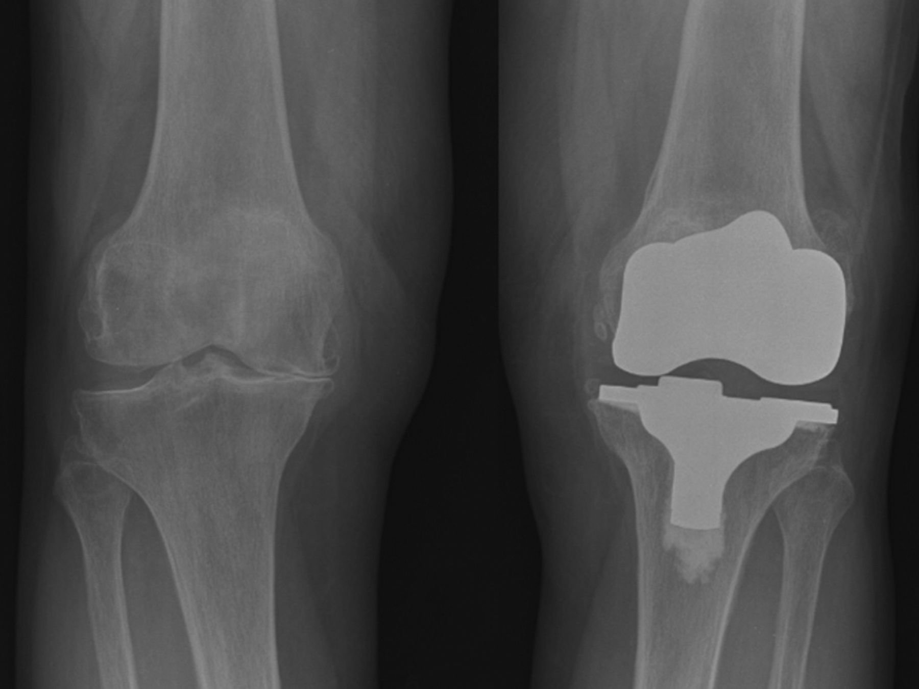 The Stiff Total Knee Arthroplasty 