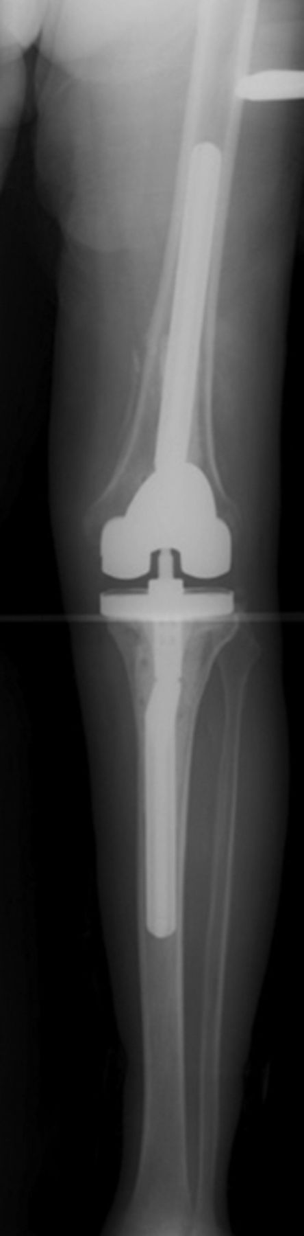 The stiff total knee arthroplasty | Bone & Joint