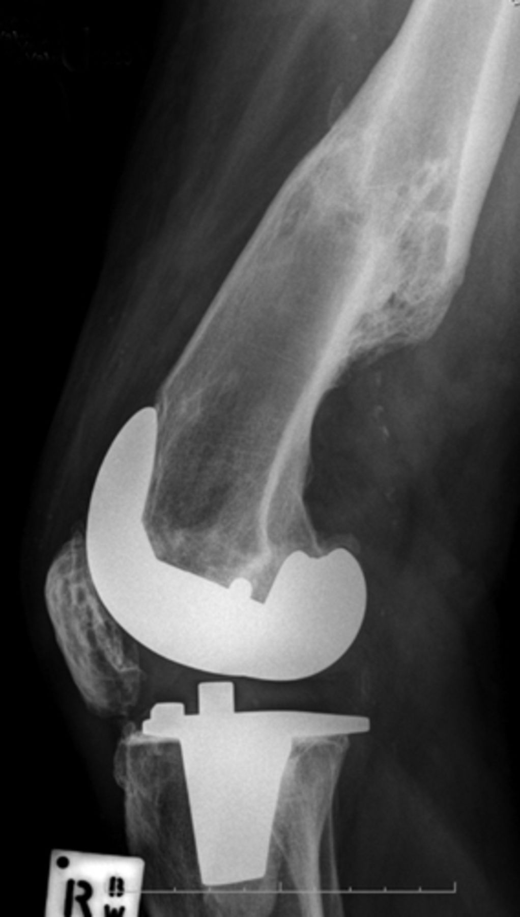 The Stiff Total Knee Arthroplasty 