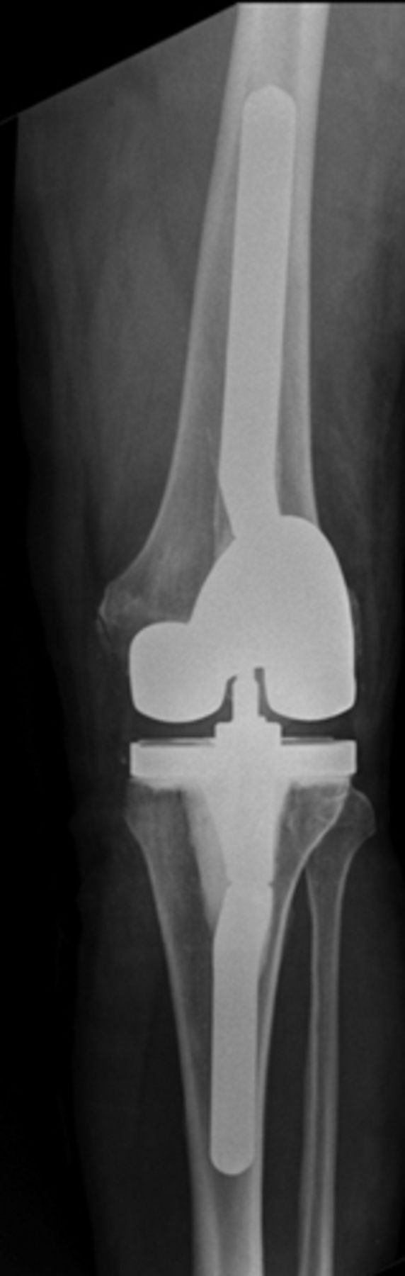 The stiff total knee arthroplasty | Bone & Joint