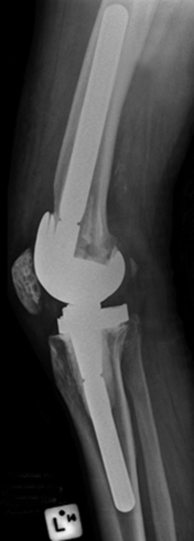 The stiff total knee arthroplasty | Bone & Joint