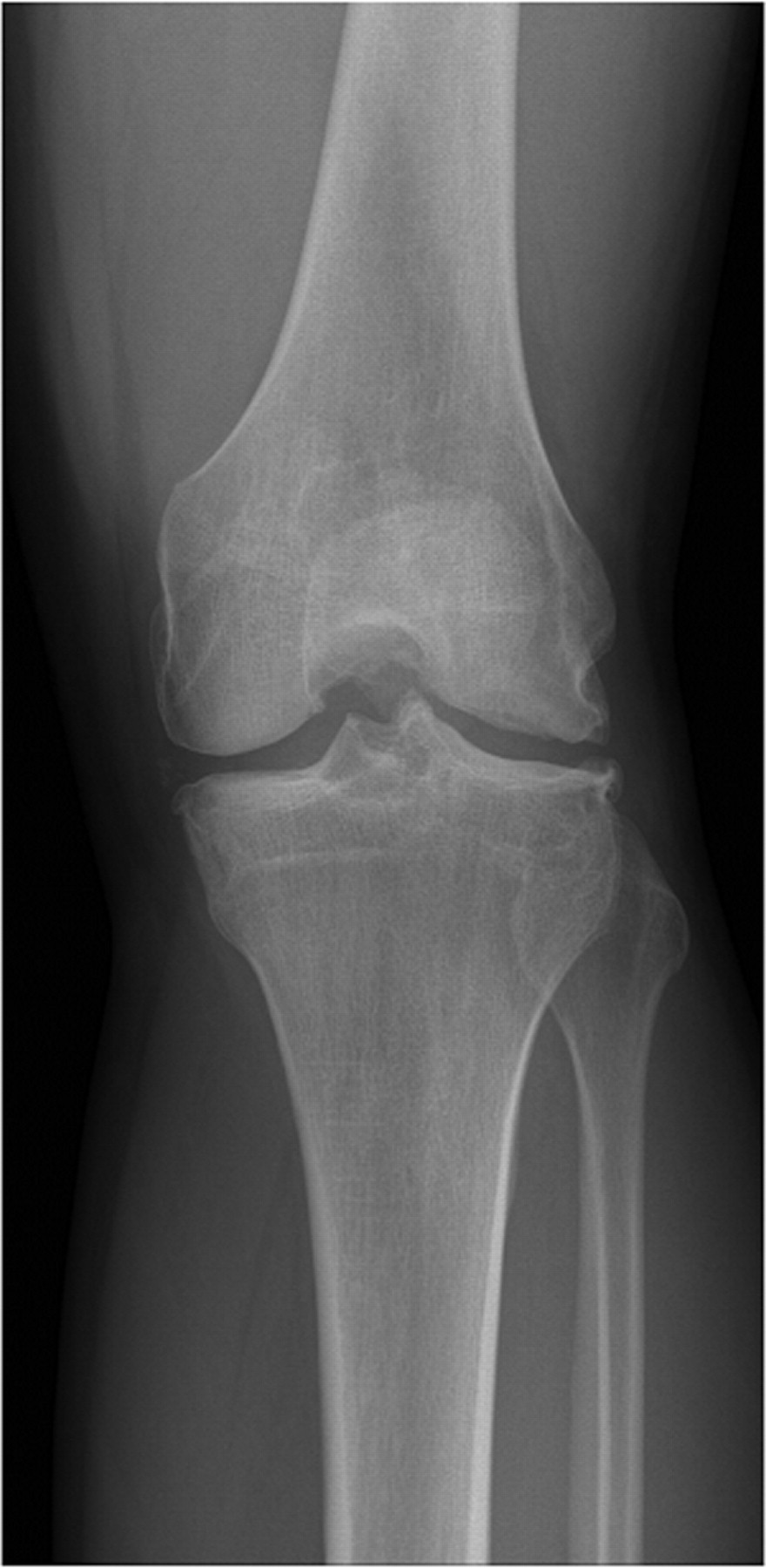 Long-term results of arthroscopic excision of unstable osteochondral ...