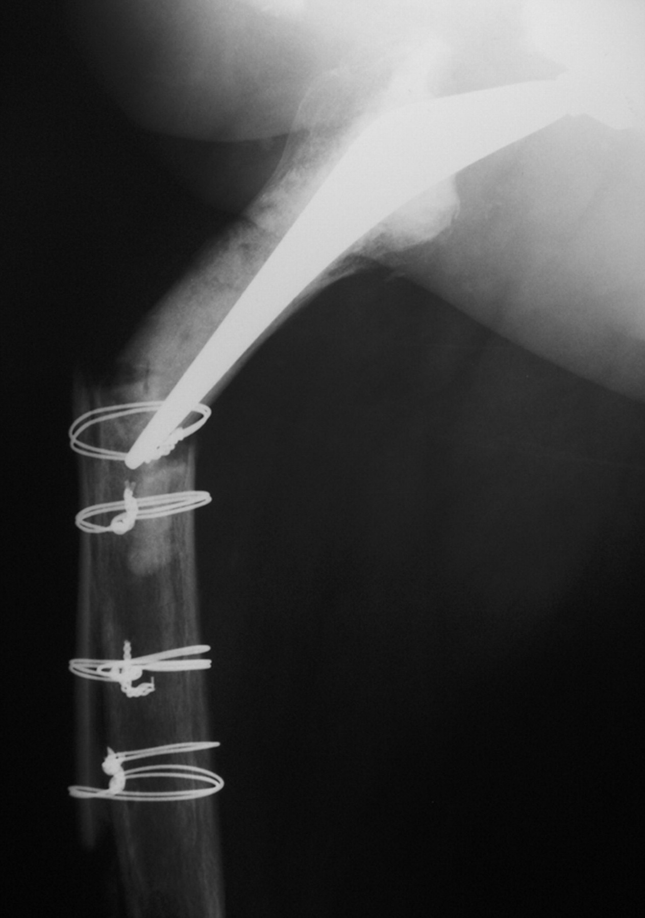 The Use Of Femoral Struts And Impacted Cancellous Bone Allograft In