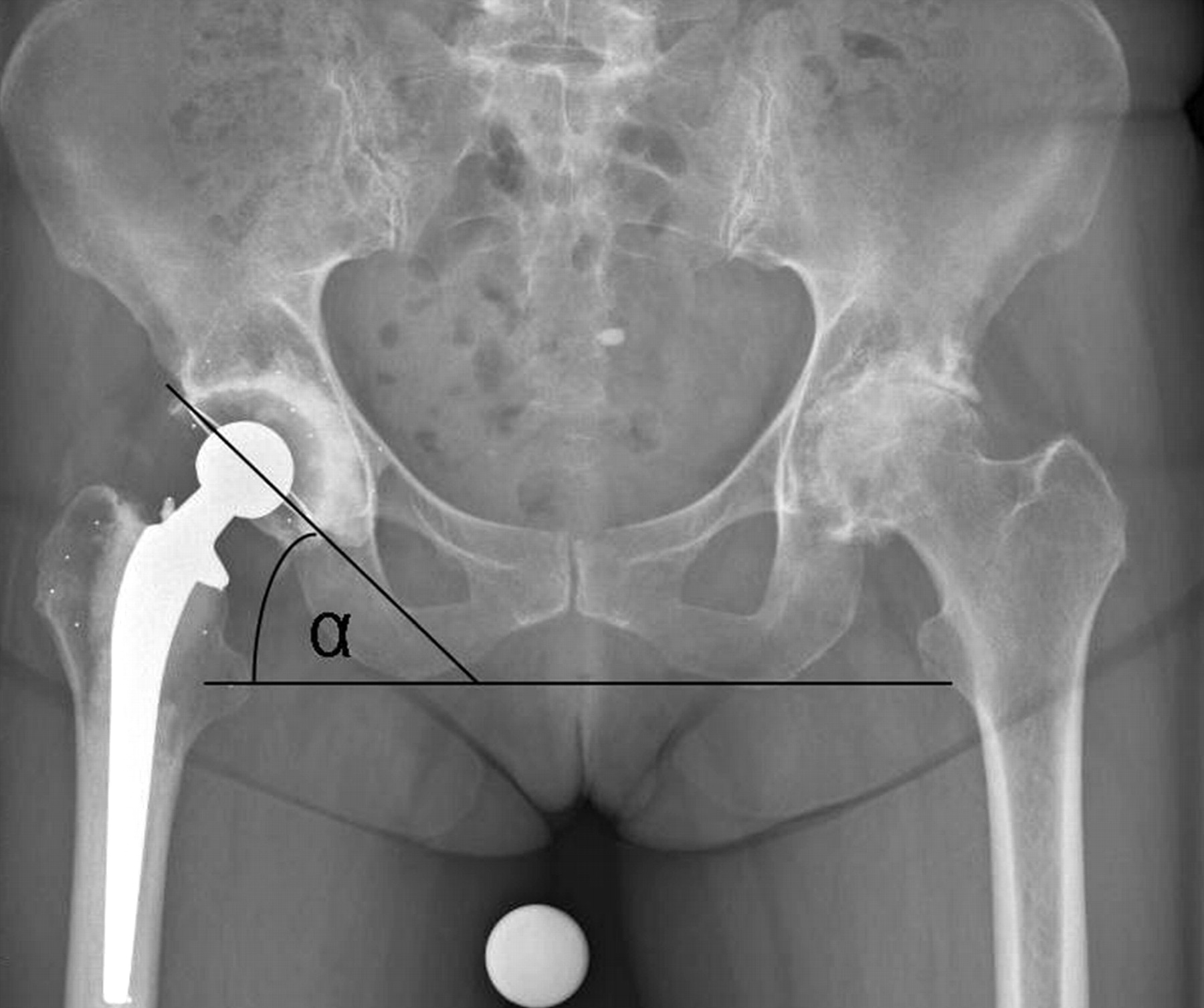 The Influence Of Acetabular Inclination Angle On The Penetration Of