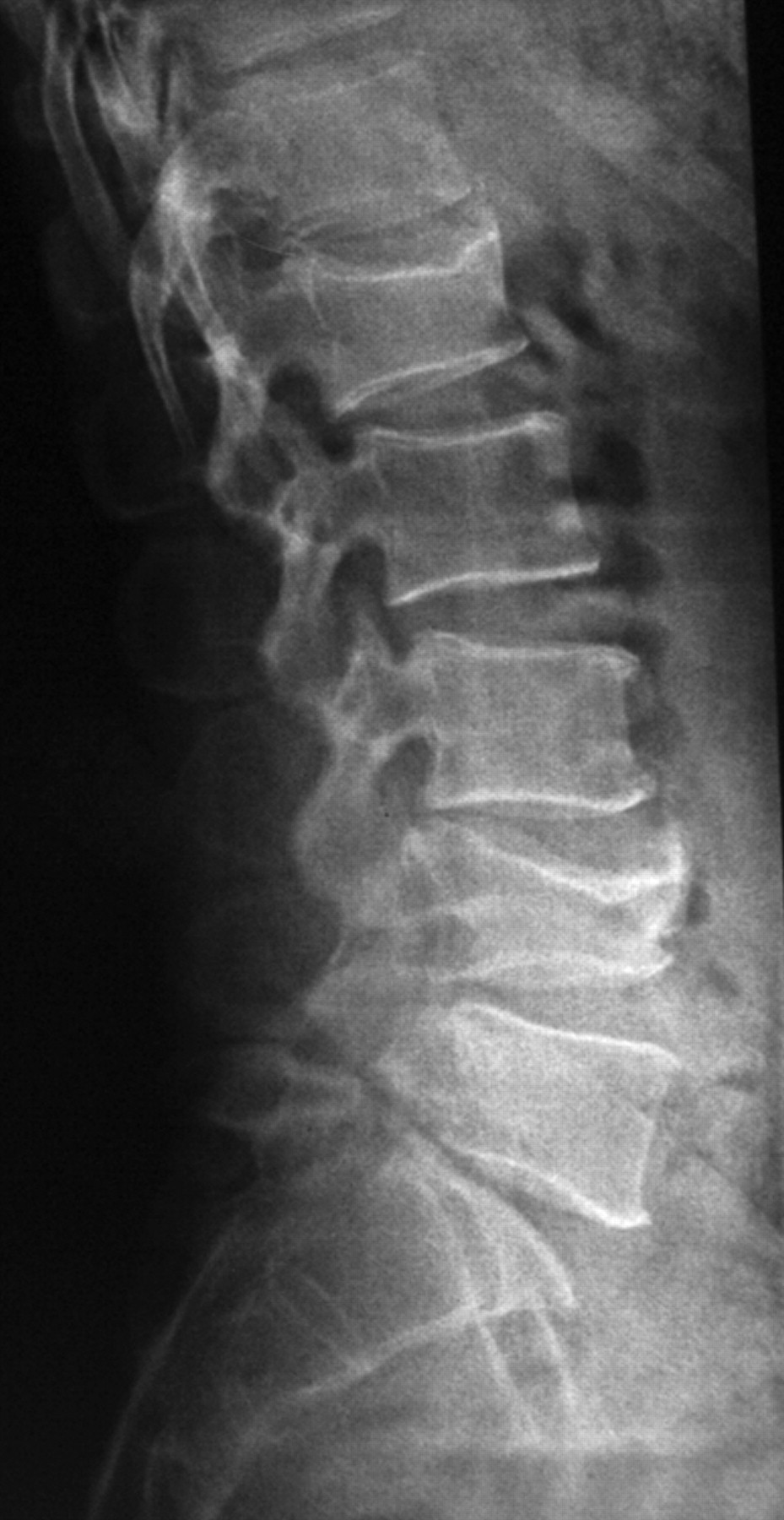 Posterior lumbar interbody fusion using spinous process and laminae ...