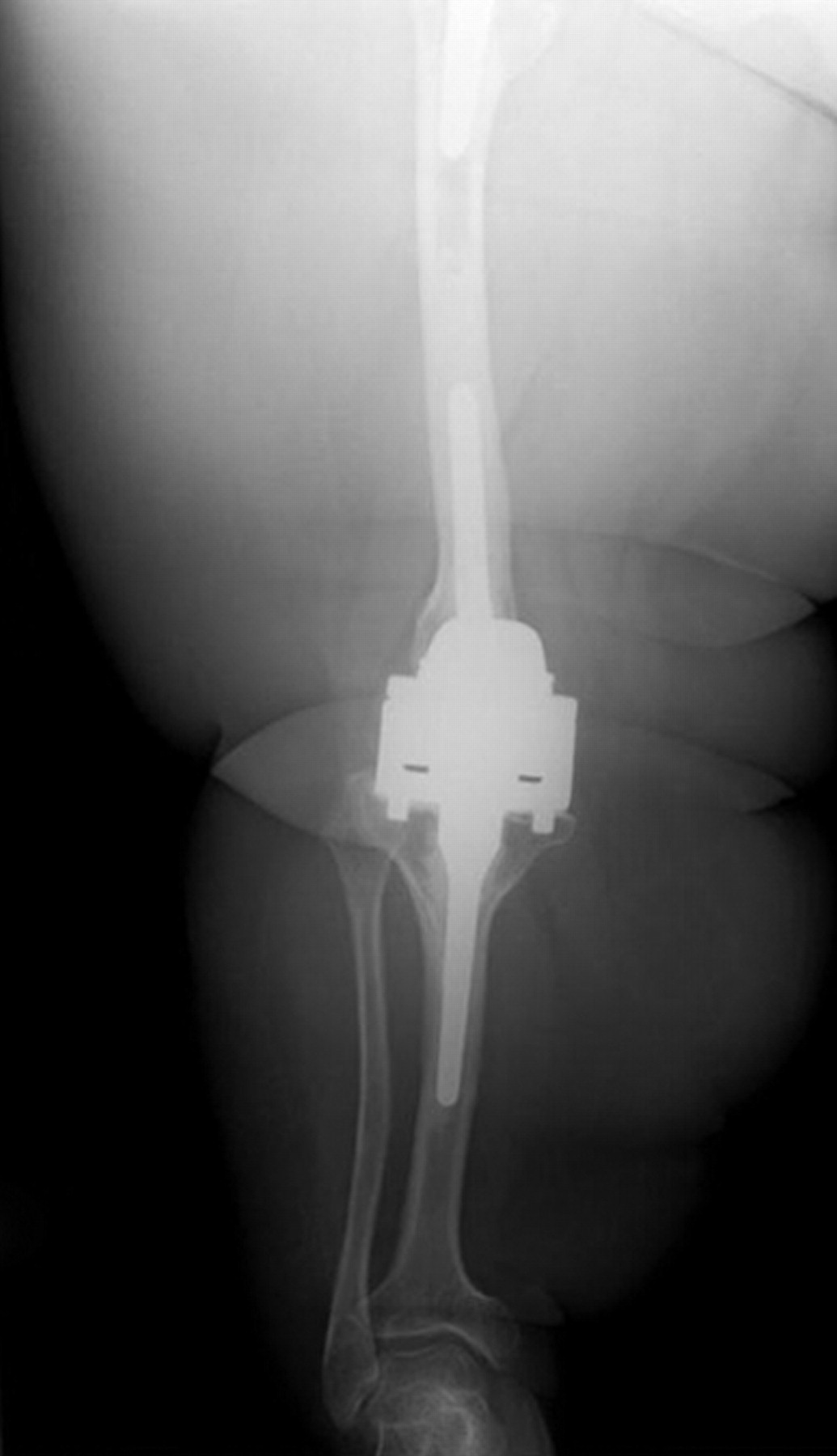 Custom Rotating-hinge Primary Total Knee Arthroplasty In Patients With ...