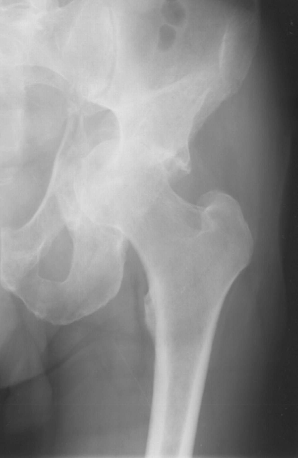 Preservation Of The Original Femoral Cement Mantle During The Management Of Infected Cemented 2675