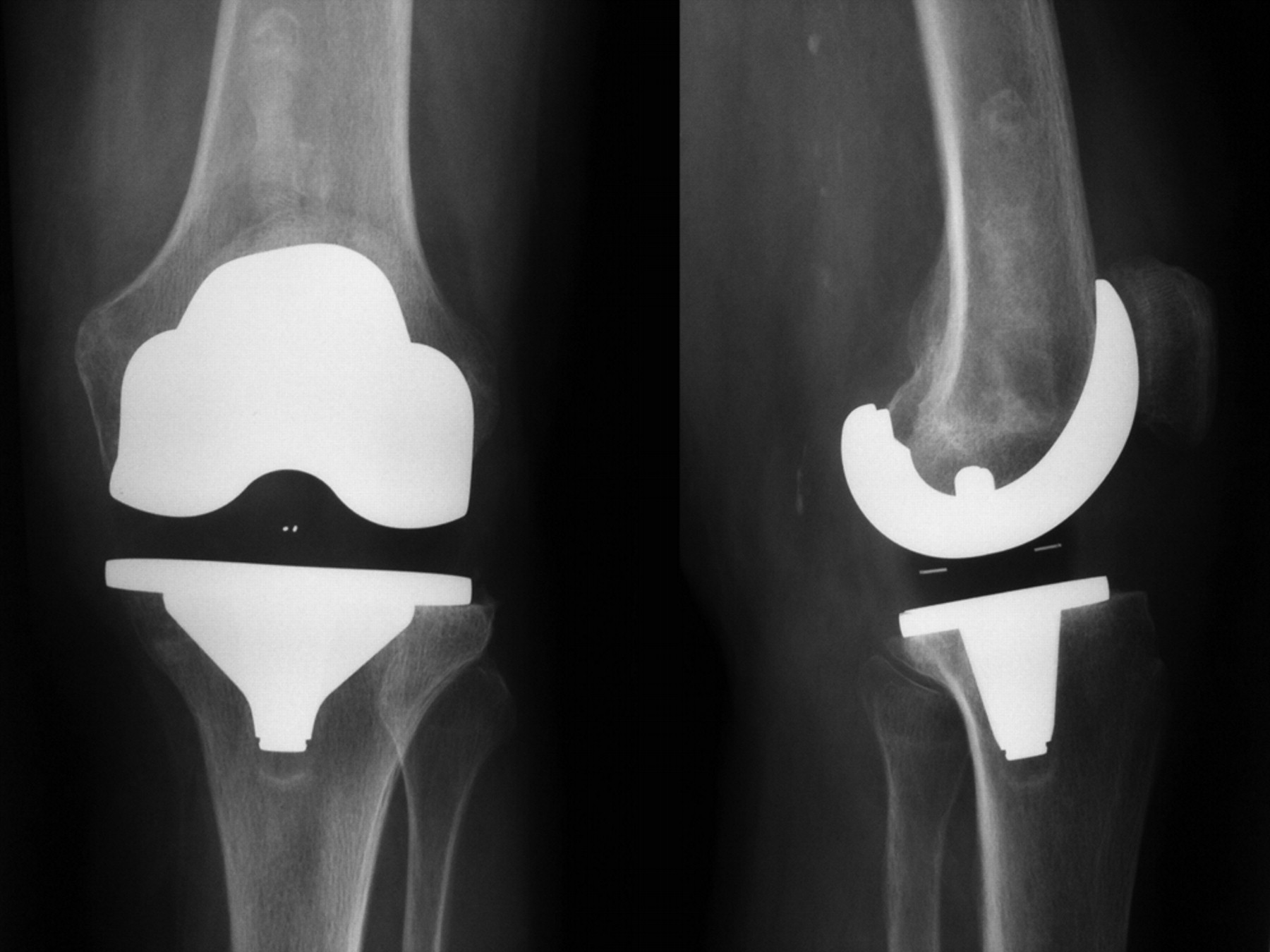 A prospective clinical and radiological study comparing hydroxyapatite ...