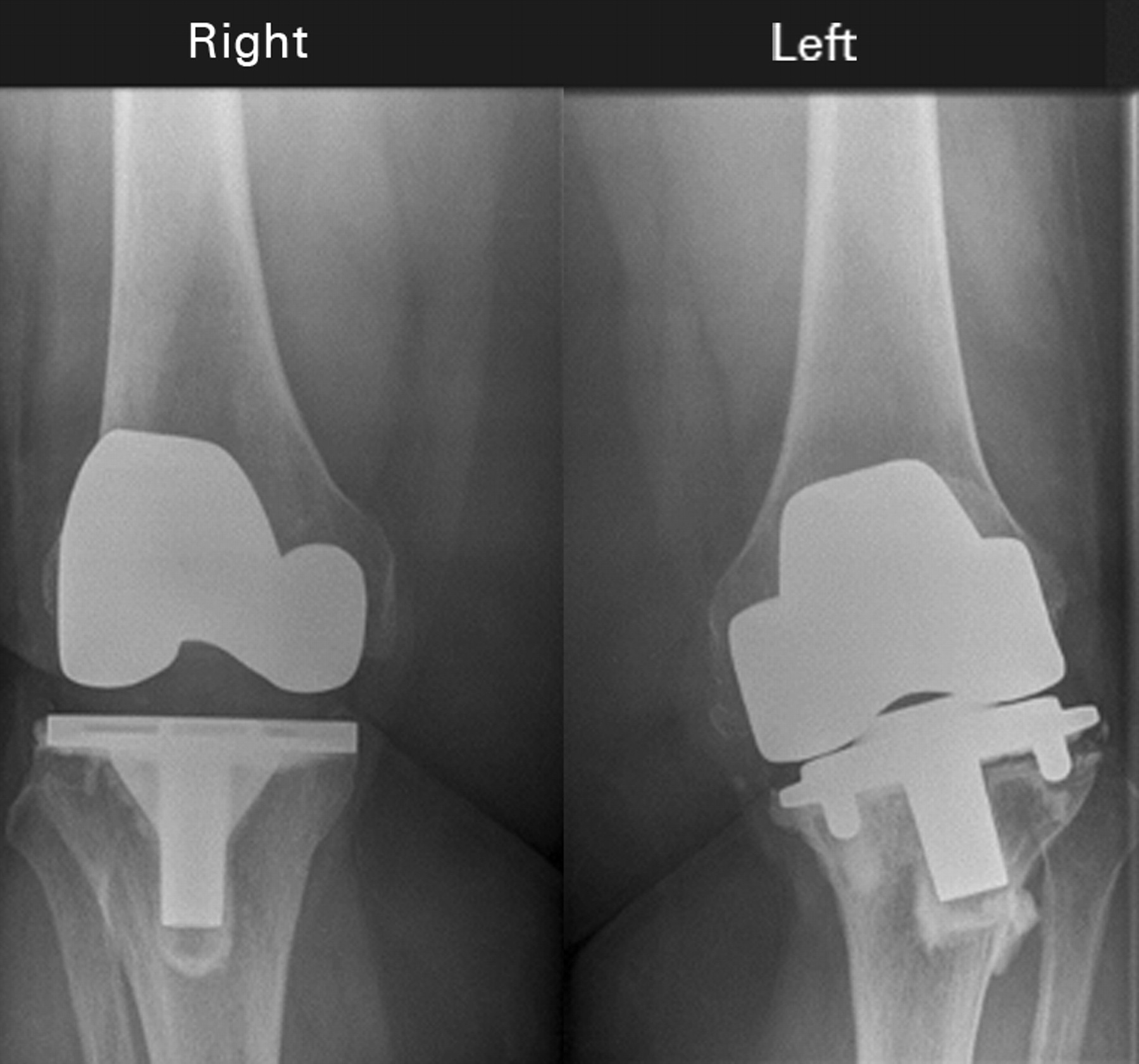 Review Of Kinemax Total Knee Replacements Performed At The Nhs