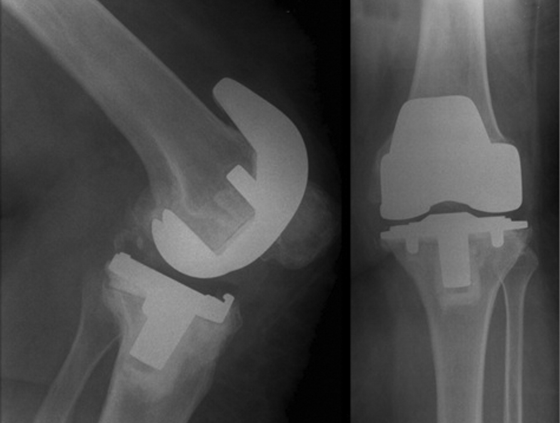 Review of Kinemax total knee replacements performed at the NHS ...