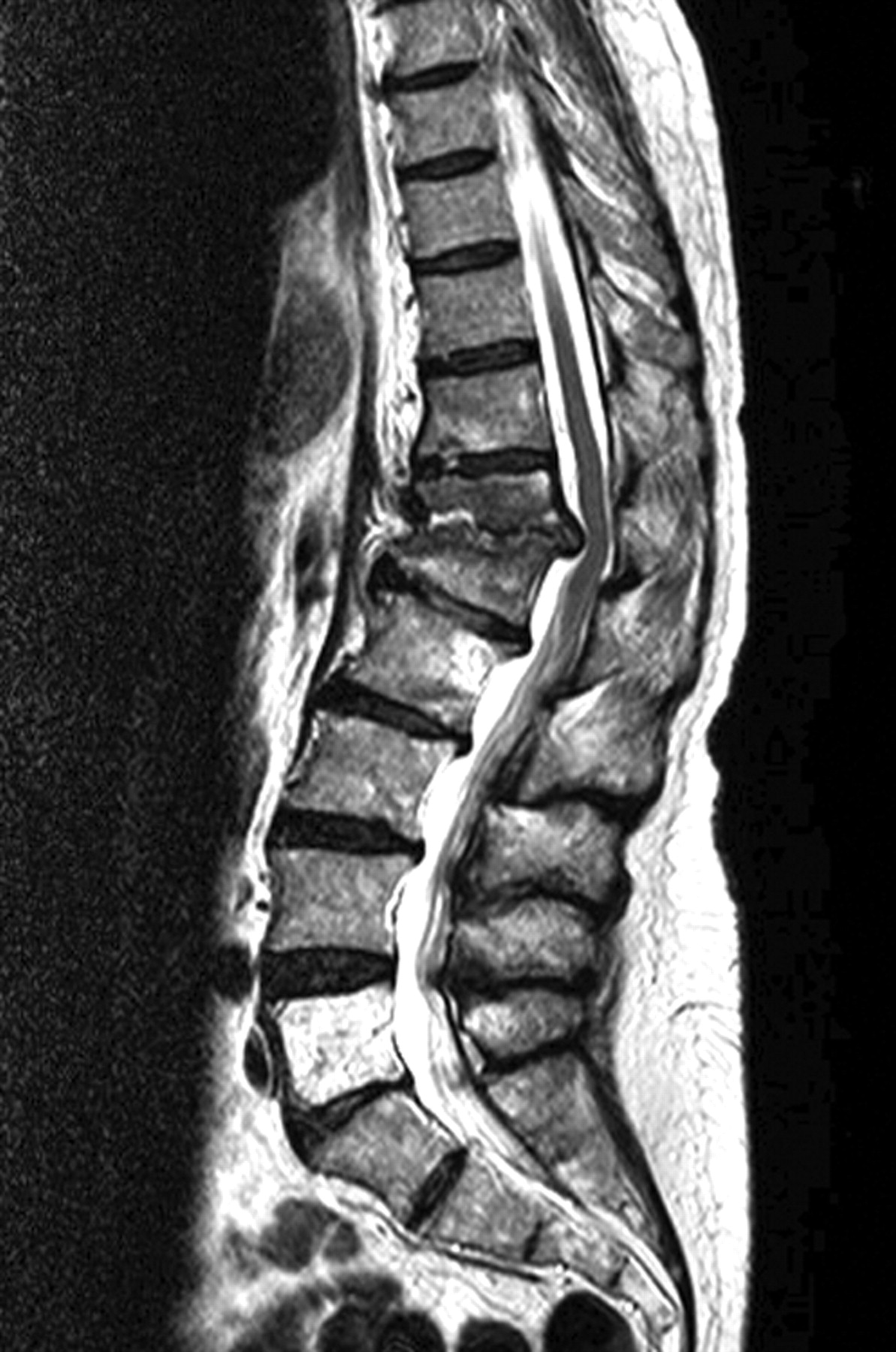 Gemella Haemolysans Spondylodiscitis Bone And Joint