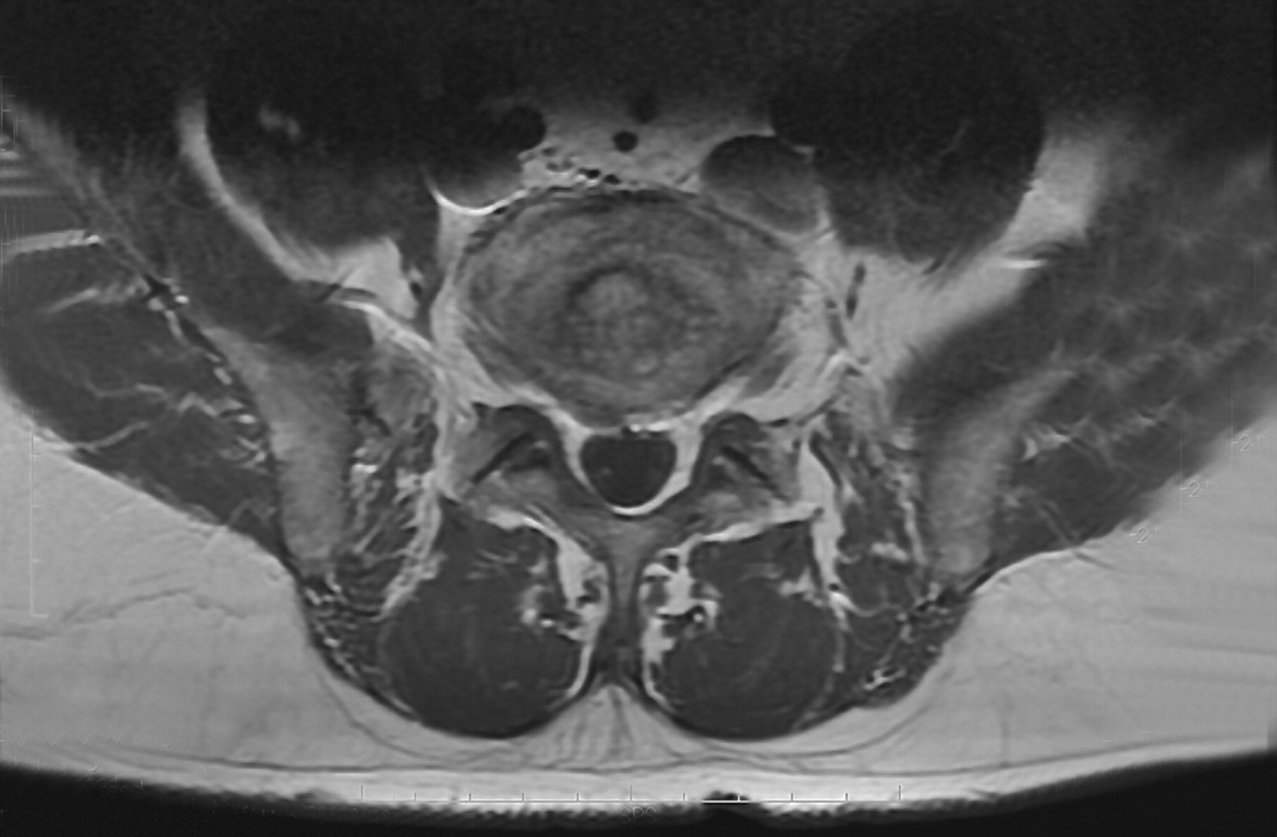 Gemella Haemolysans Spondylodiscitis 