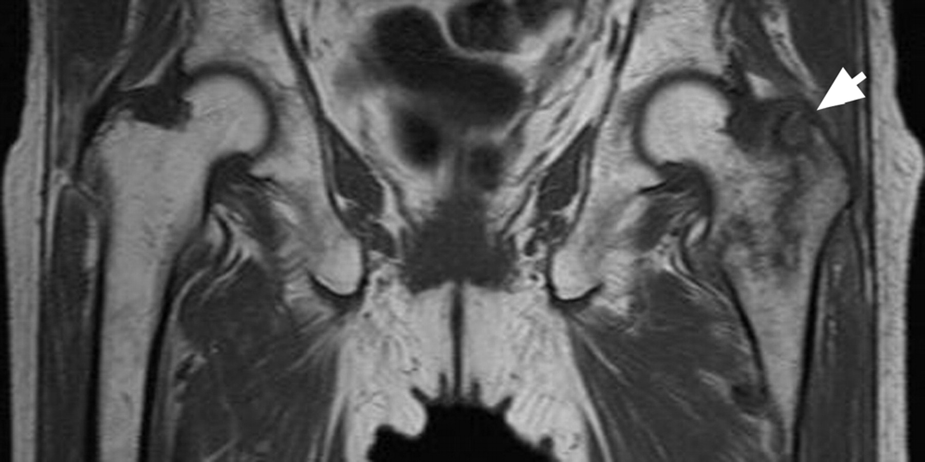 The value of T1-weighted coronal MRI scans in diagnosing occult ...