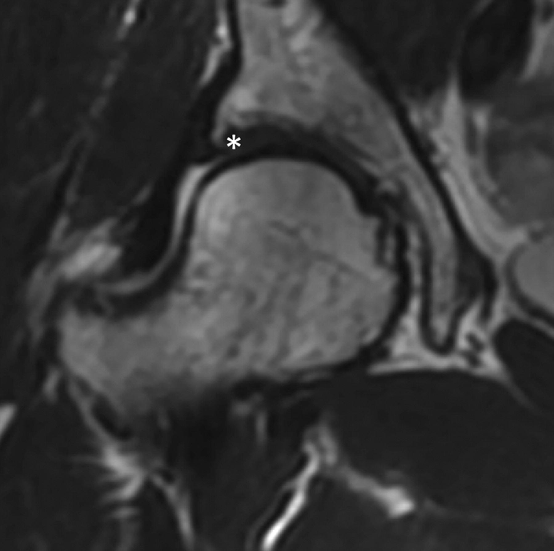 Arthroscopic partial limbectomy for labral injury of the hip | Bone & Joint