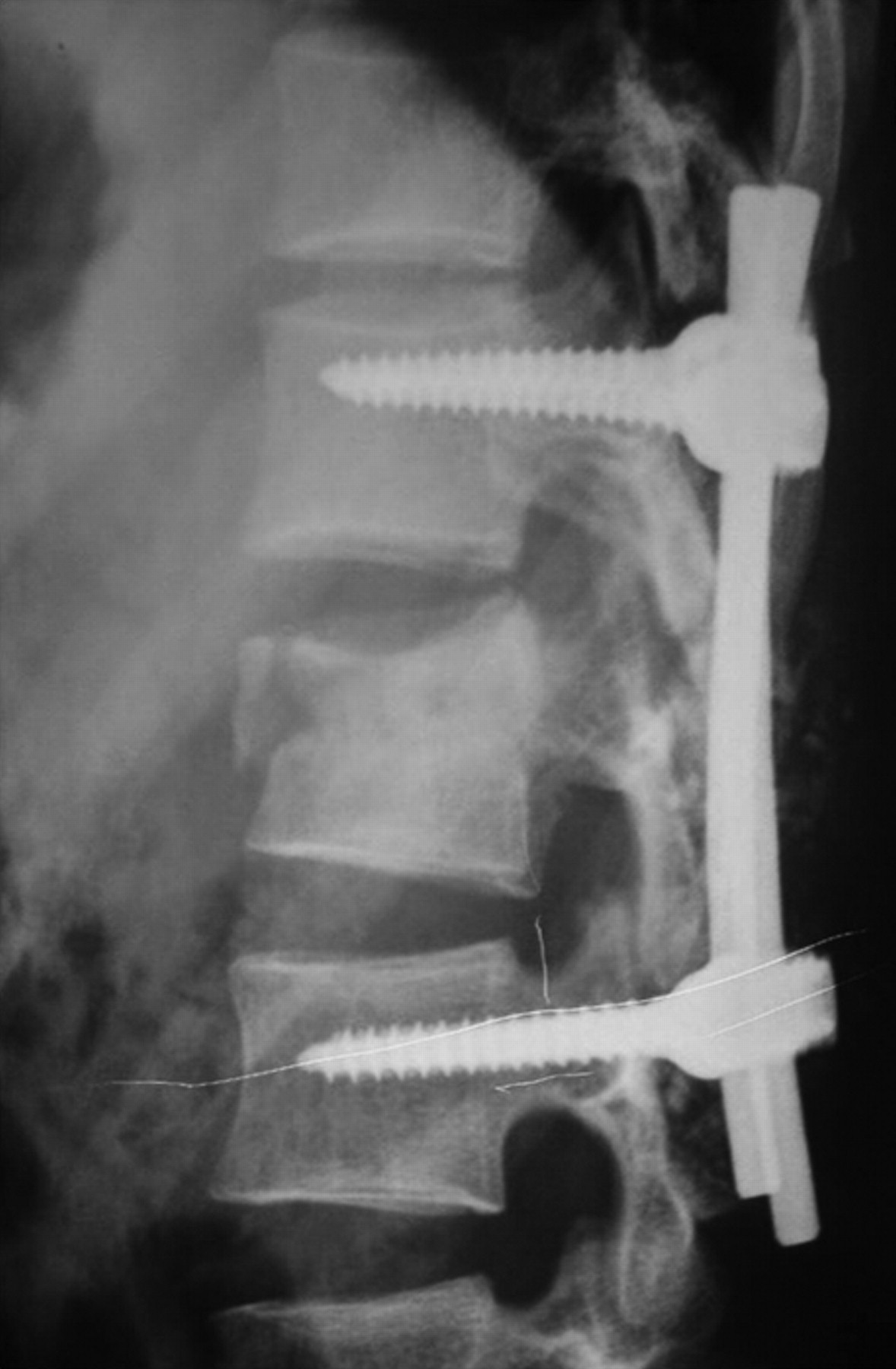 The Role Of Fusion In The Management Of Burst Fractures Of The Thoracolumbar Spine Treated By 