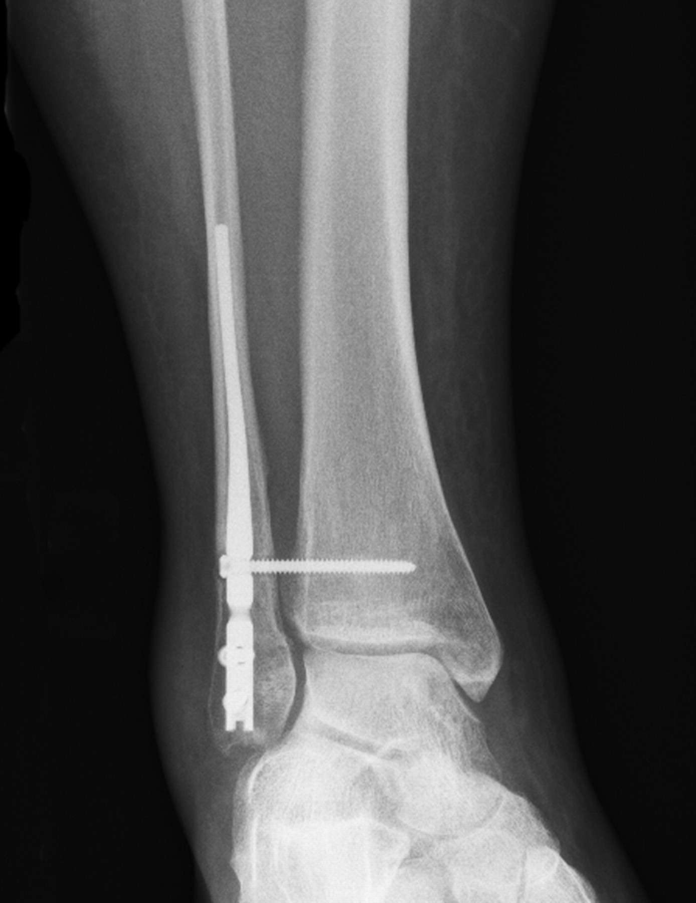 The treatment of unstable fractures of the ankle using the Acumed ...