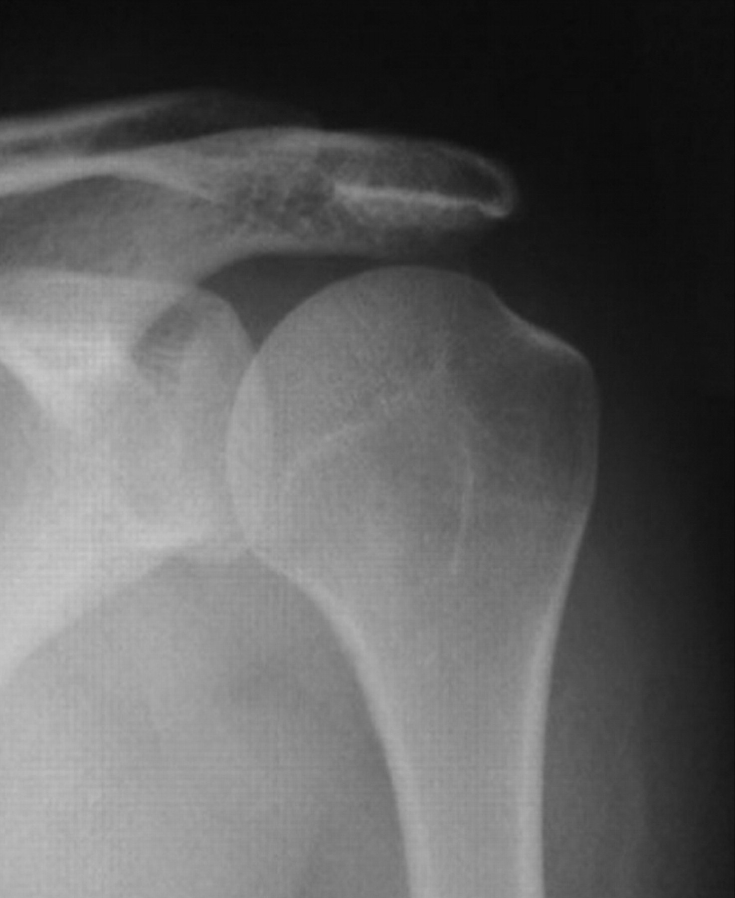 Arthroscopic Subacromial Decompression Is Effective In Selected 