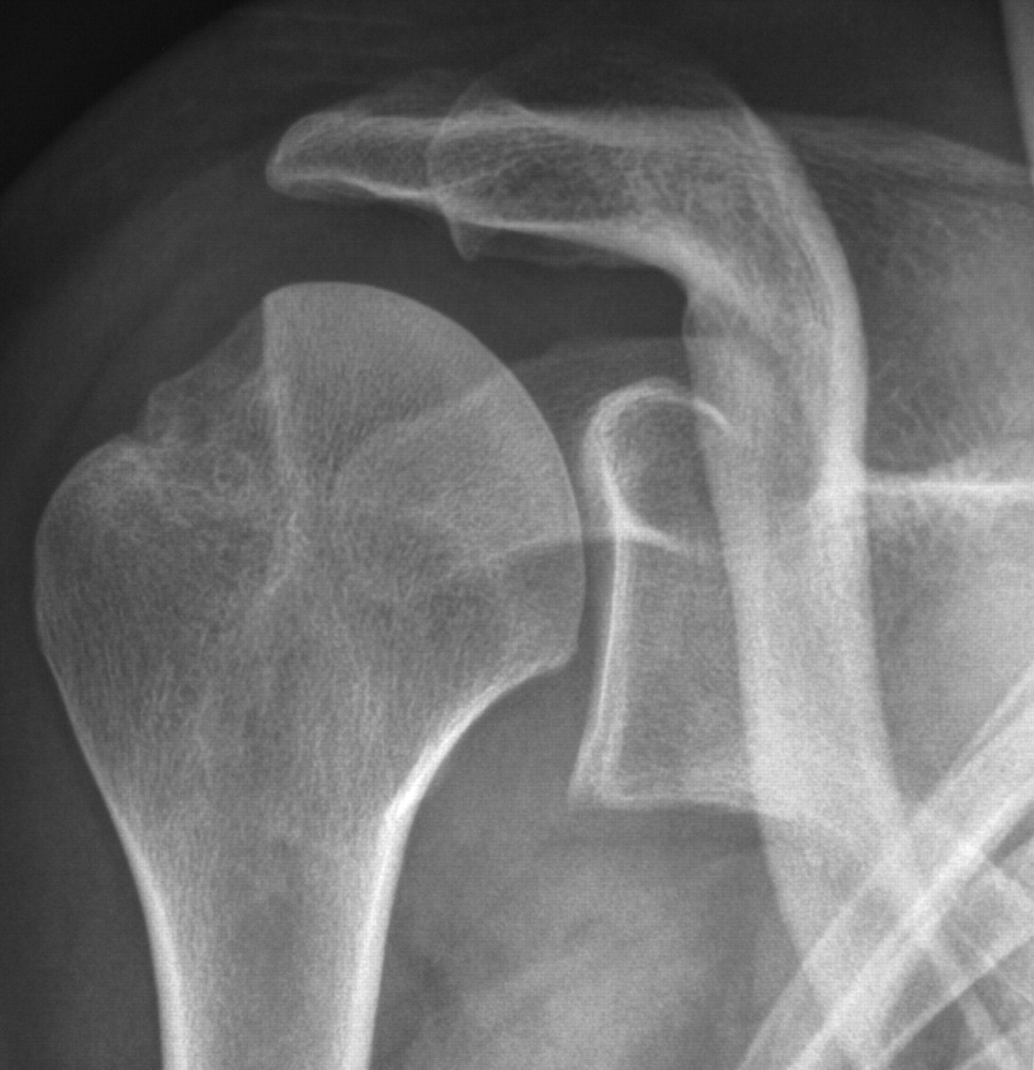 Results of the Latarjet procedure for recurrent anterior dislocation of ...