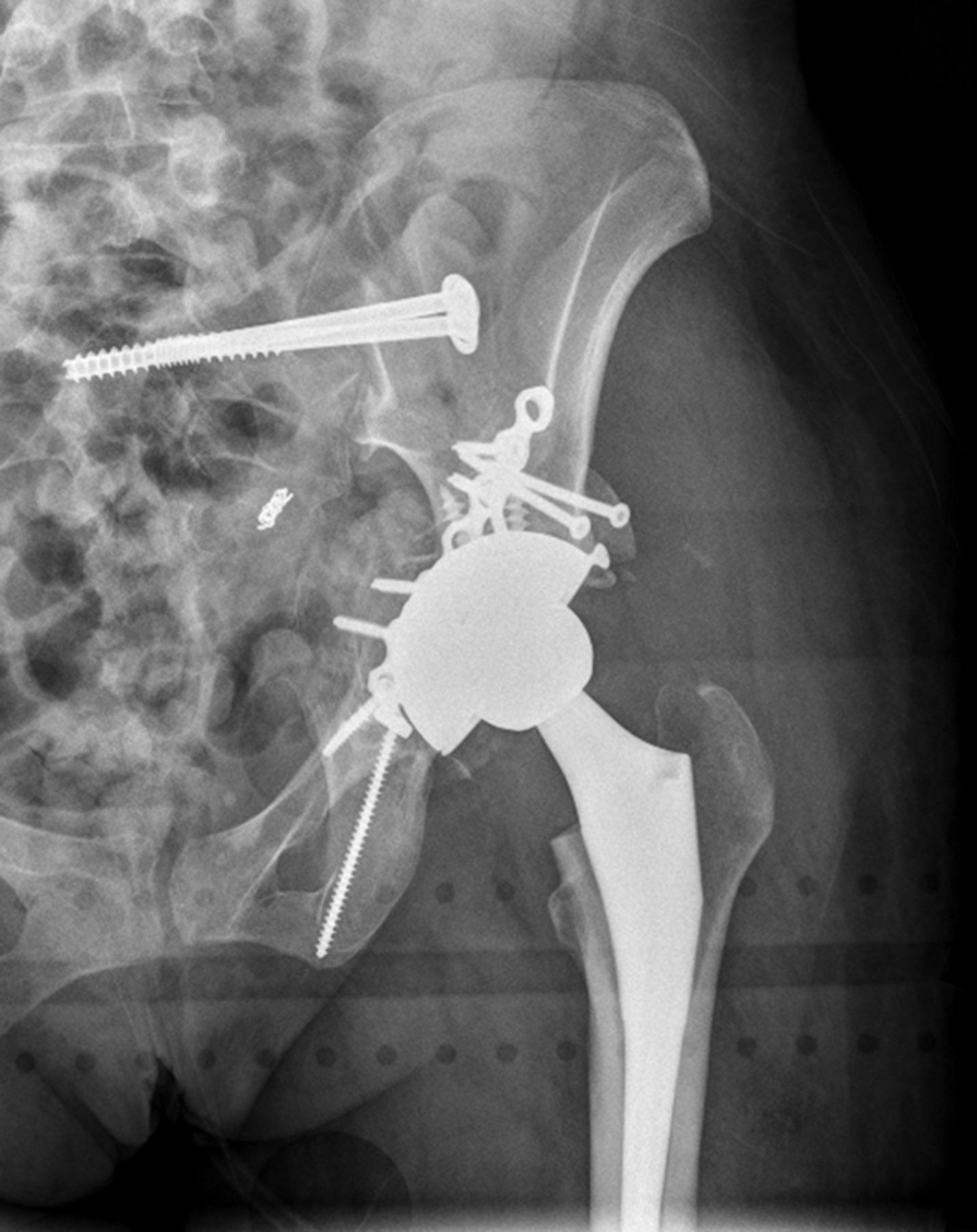 Heterotopic Ossification Following Total Hip Replacement For Acetabular Fractures Bone And Joint