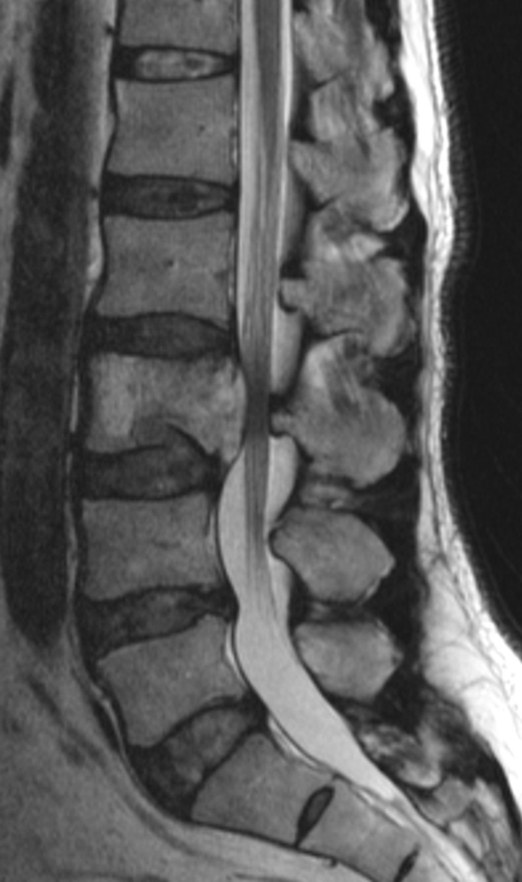 Total spondylectomy following carbon ion radiotherapy to treat chordoma ...