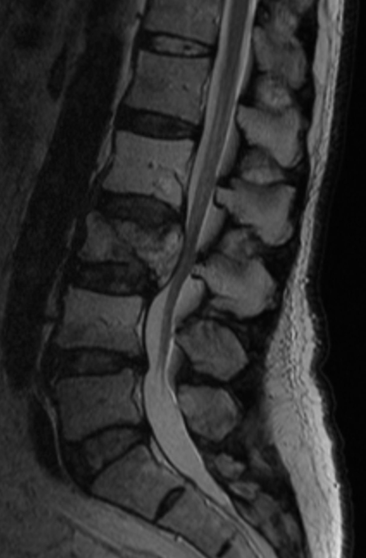 Total spondylectomy following carbon ion radiotherapy to treat chordoma ...