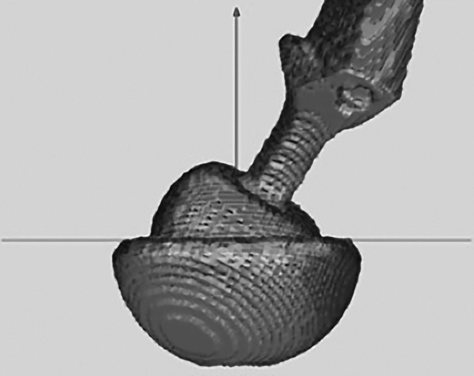 Functional Acetabular Component Position With Supine Total Hip Replacement Bone And Joint 4698