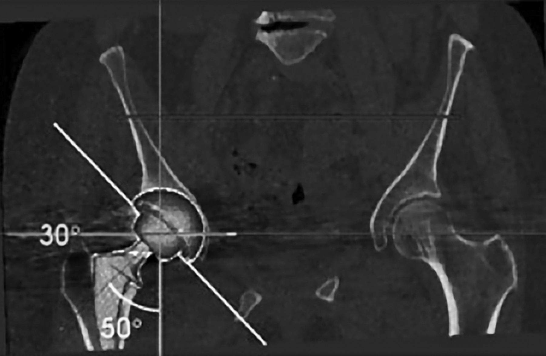 Functional Acetabular Component Position With Supine Total Hip Replacement Bone And Joint 3635