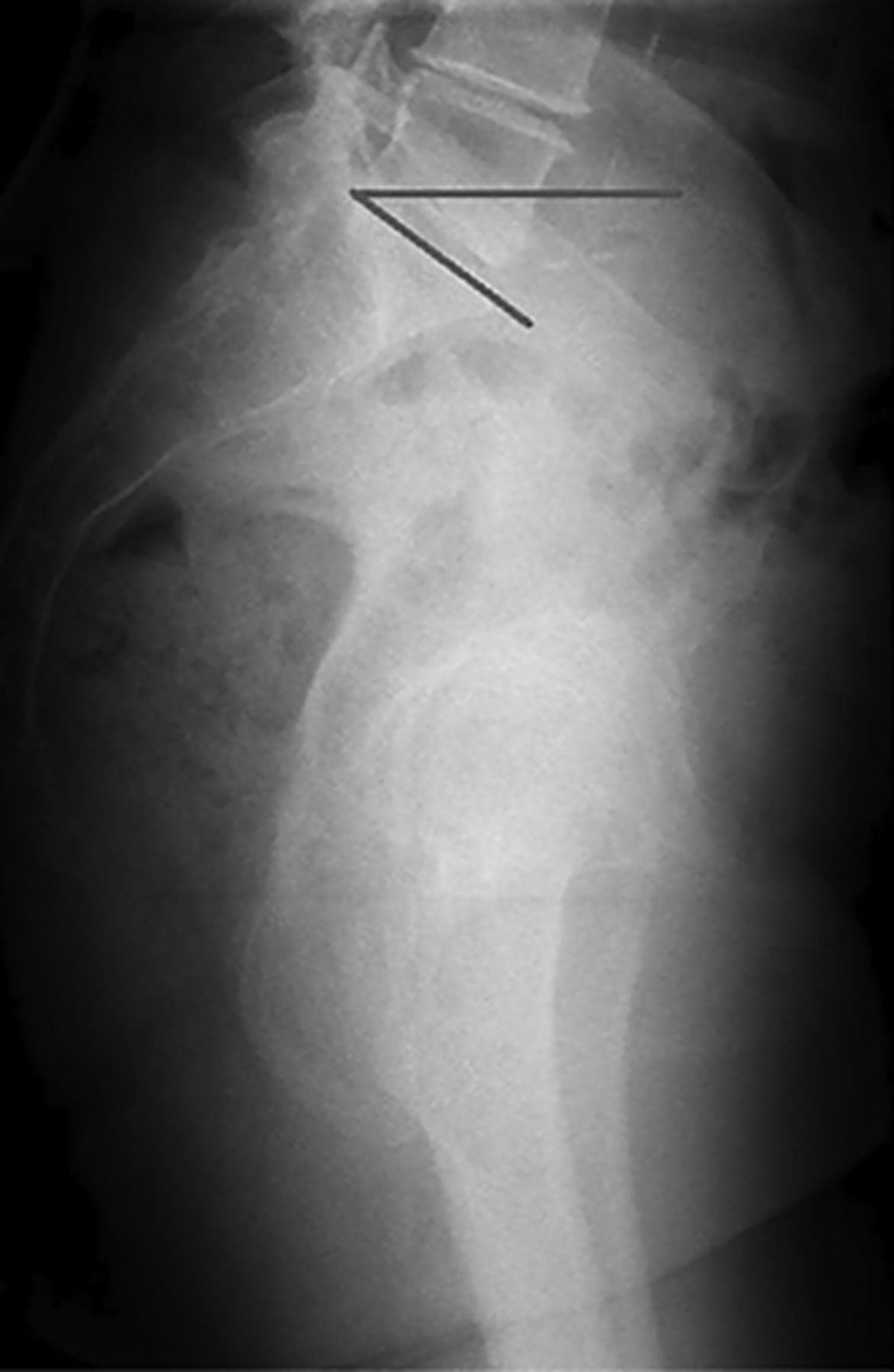 Functional acetabular component position with supine total hip ...