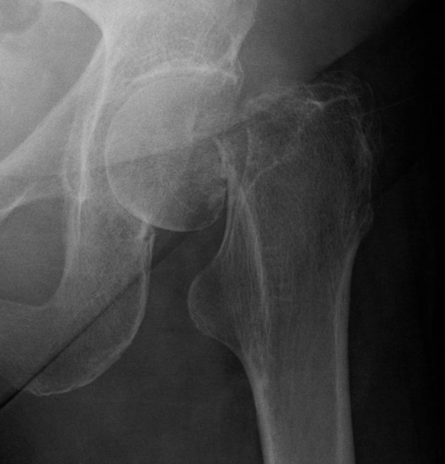 Internal fixation of intracapsular fractures of the hip using a dynamic ...