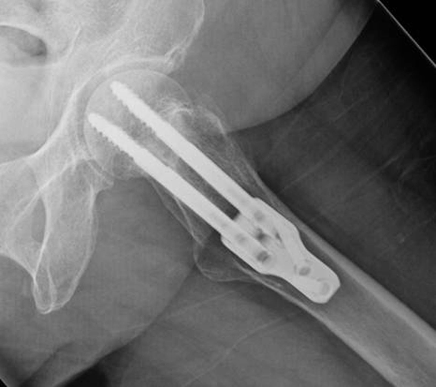 Internal Fixation Of Intracapsular Fractures Of The Hip Using A Dynamic Locking Plate Bone And Joint