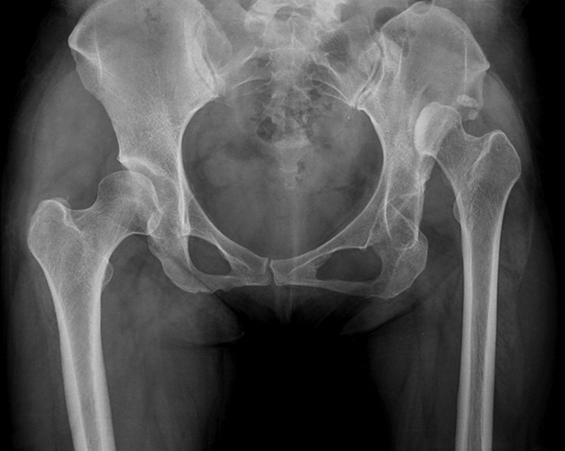 Improving Pre Operative Planning For Complex Total Hip Replacement With A Rapid Prototype Model 3392