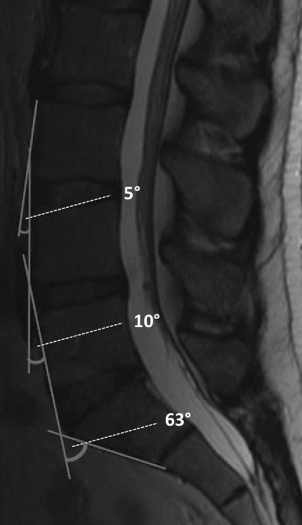 A reliable measurement for identifying a lumbosacral transitional ...