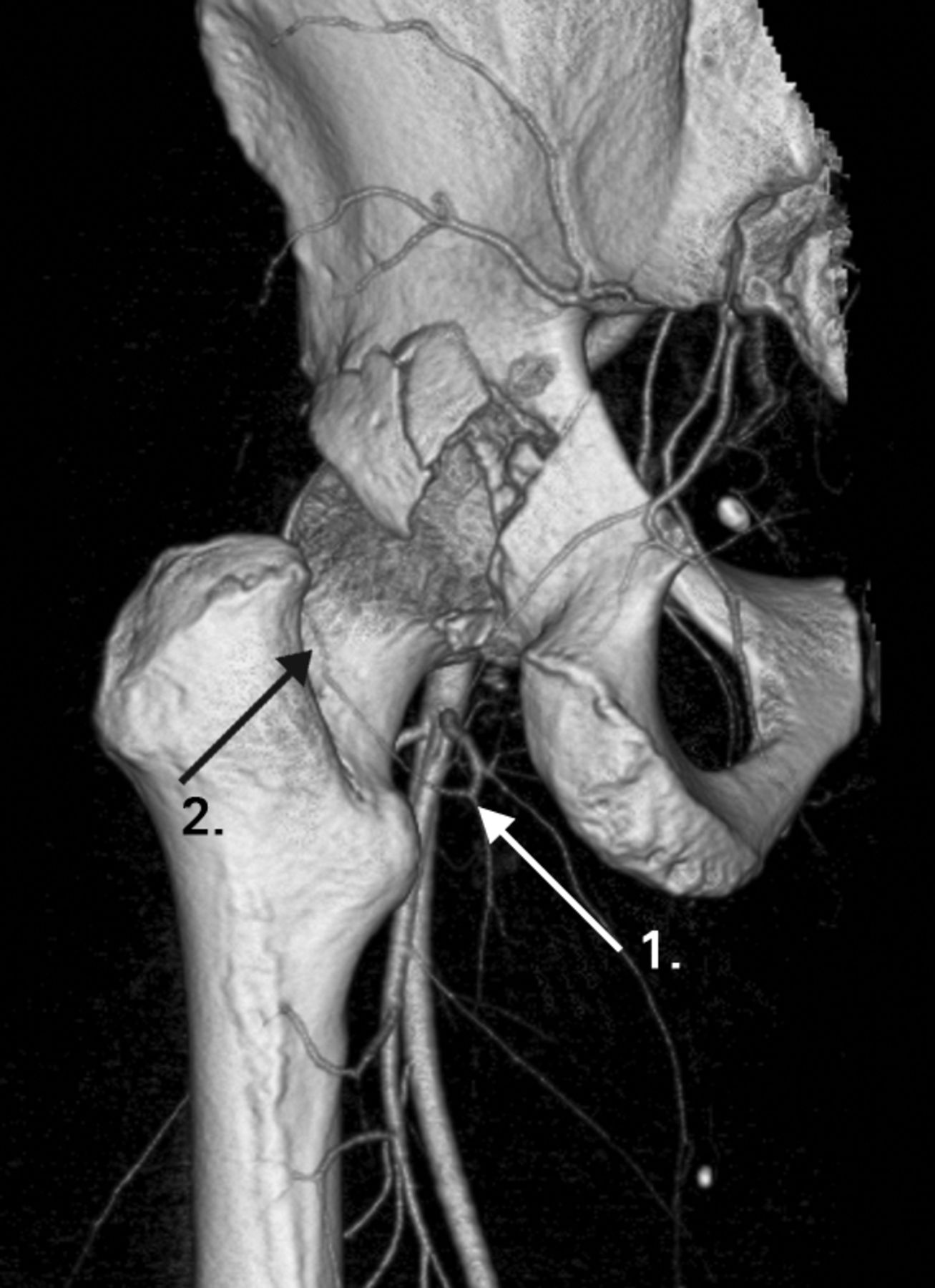 the-blood-supply-to-the-femoral-head-after-posterior-fracture