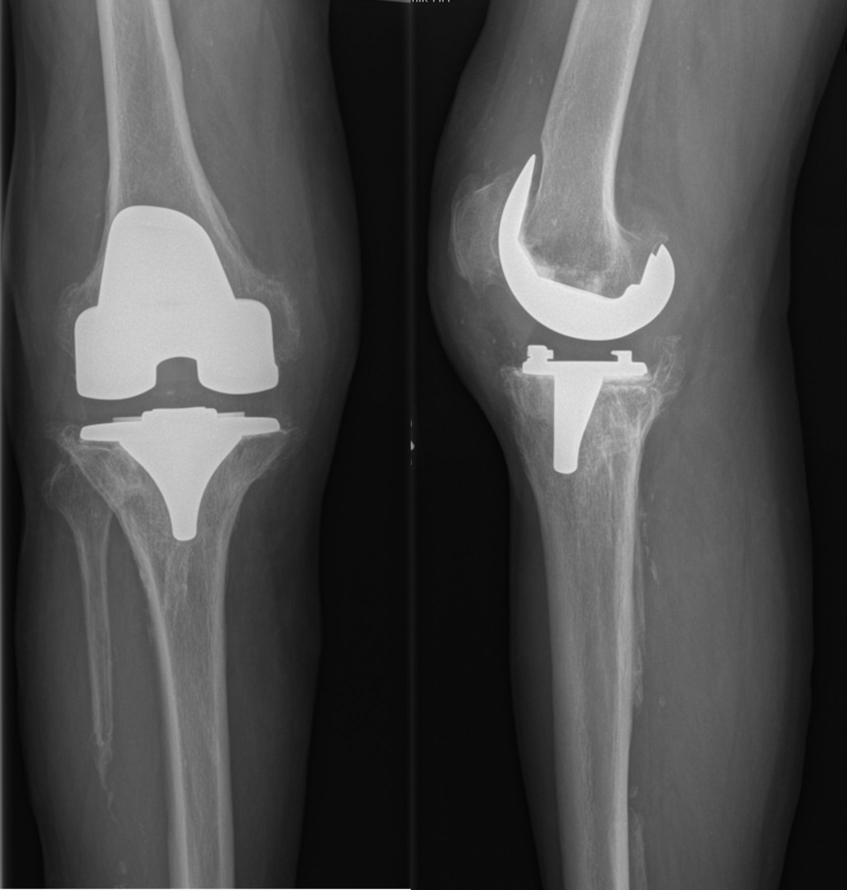 One-stage exchange | Bone & Joint