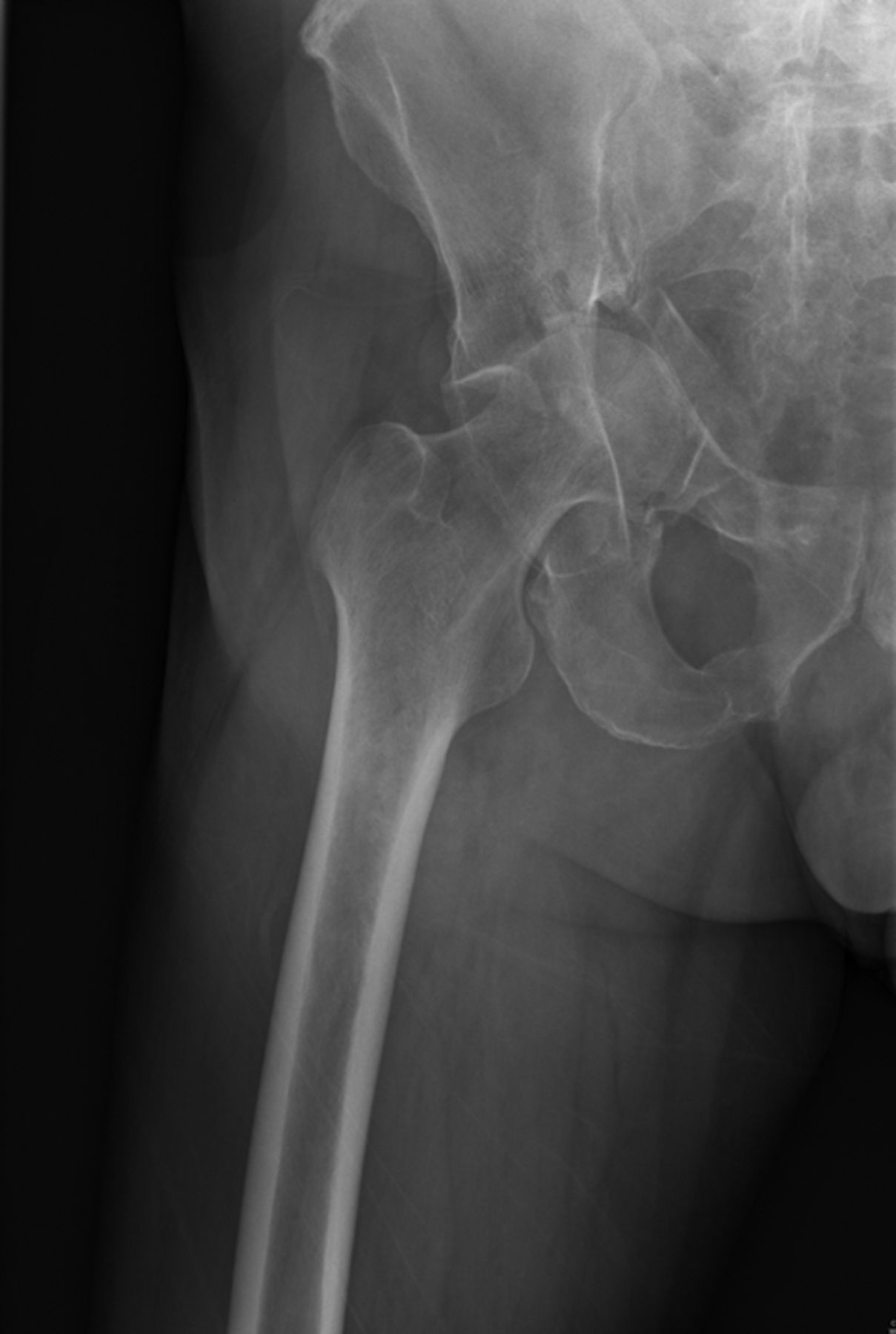 Pelvic discontinuity | Bone & Joint