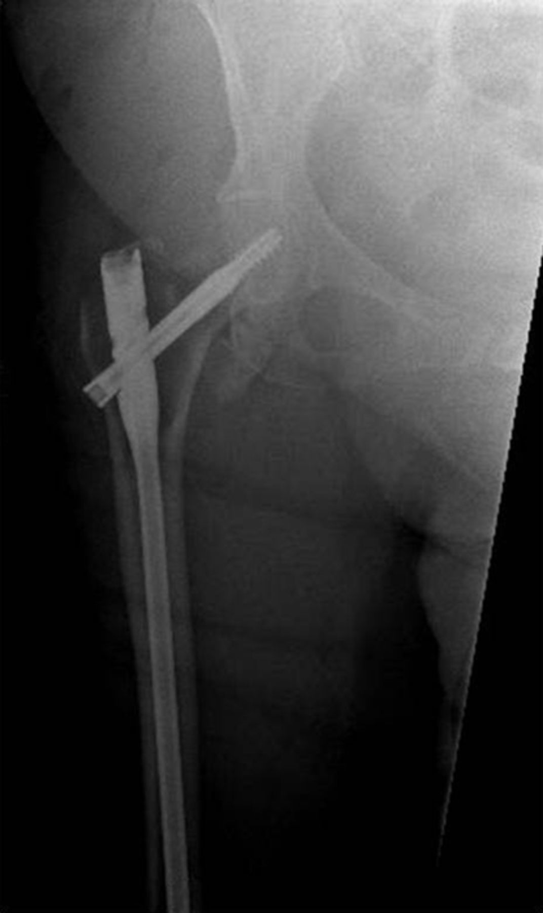 When femoral fracture fixation fails | Bone & Joint