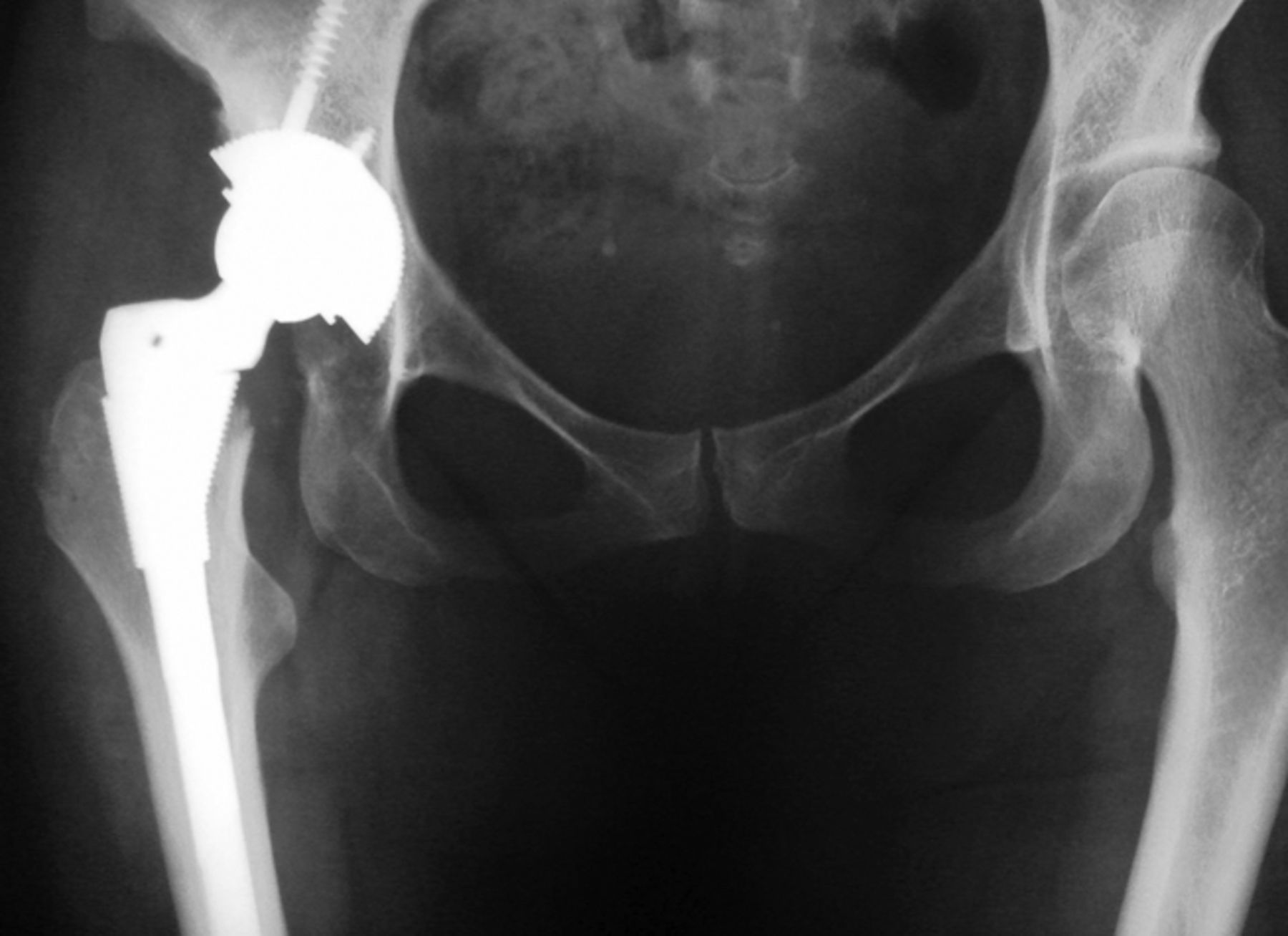 The dysplastic hip | Bone & Joint