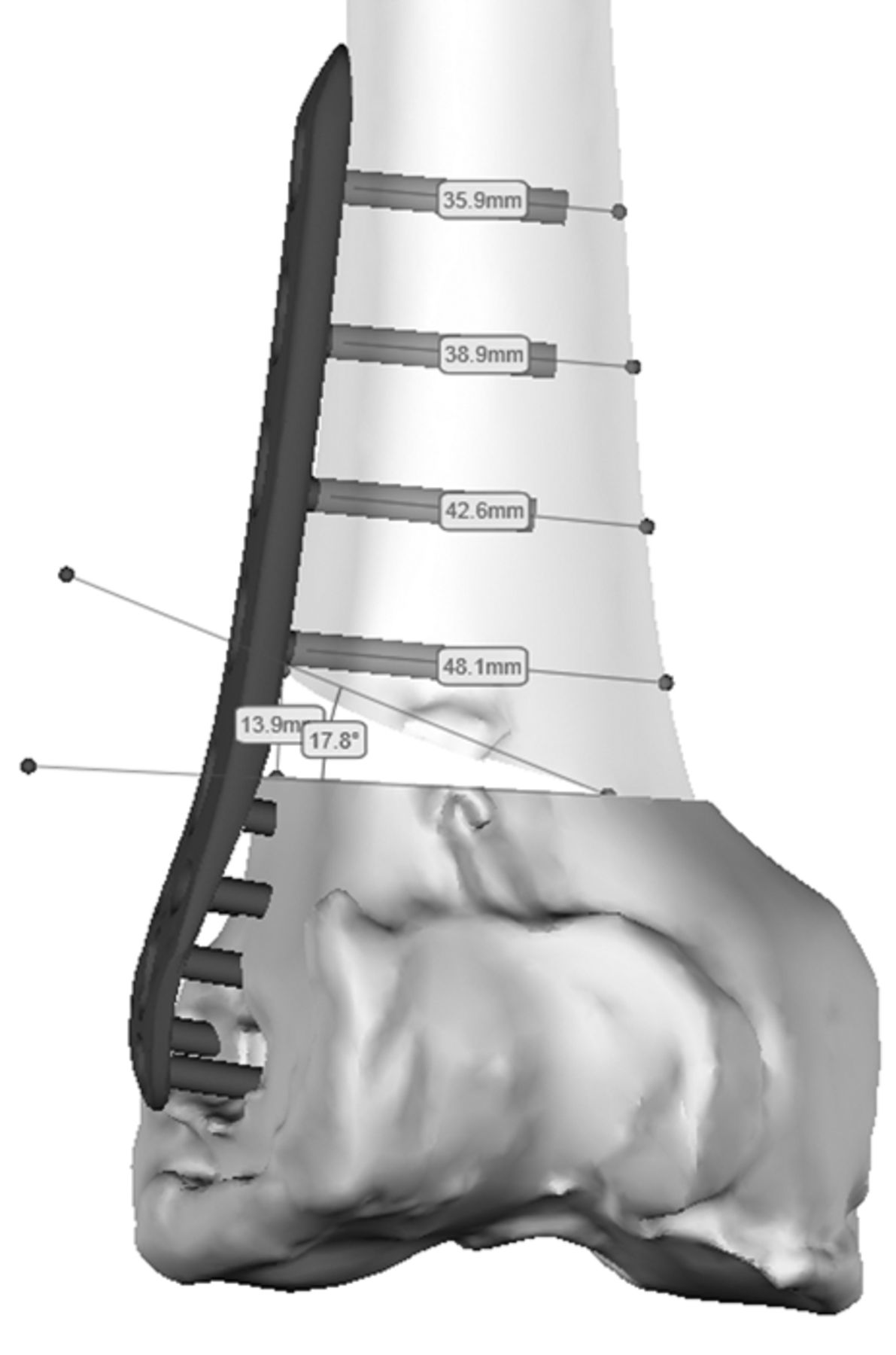 Virtual 3D Planning And Patient Specific#N#surgical Guides For ...