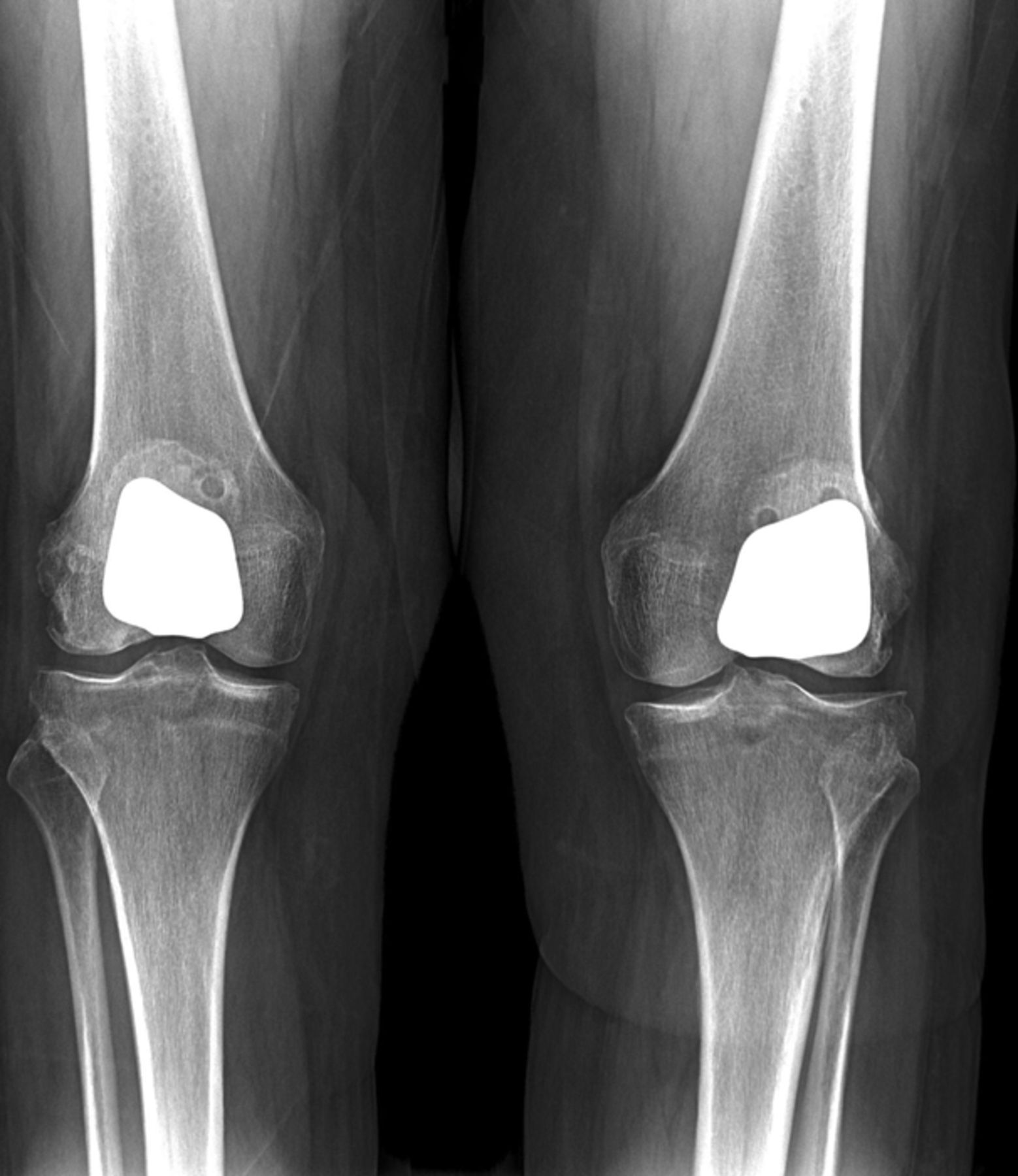 Patellofemoral replacement | Bone & Joint