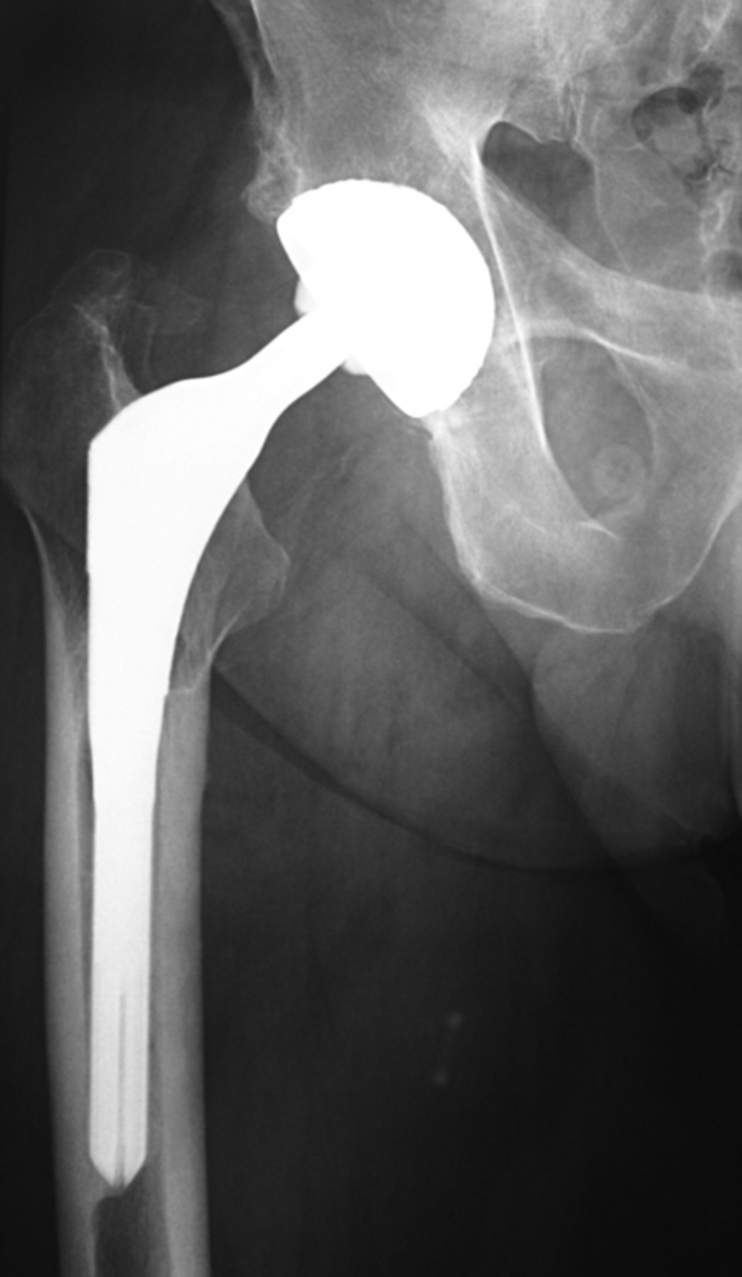 Ceramic-on-ceramic bearings in young patients | Bone & Joint