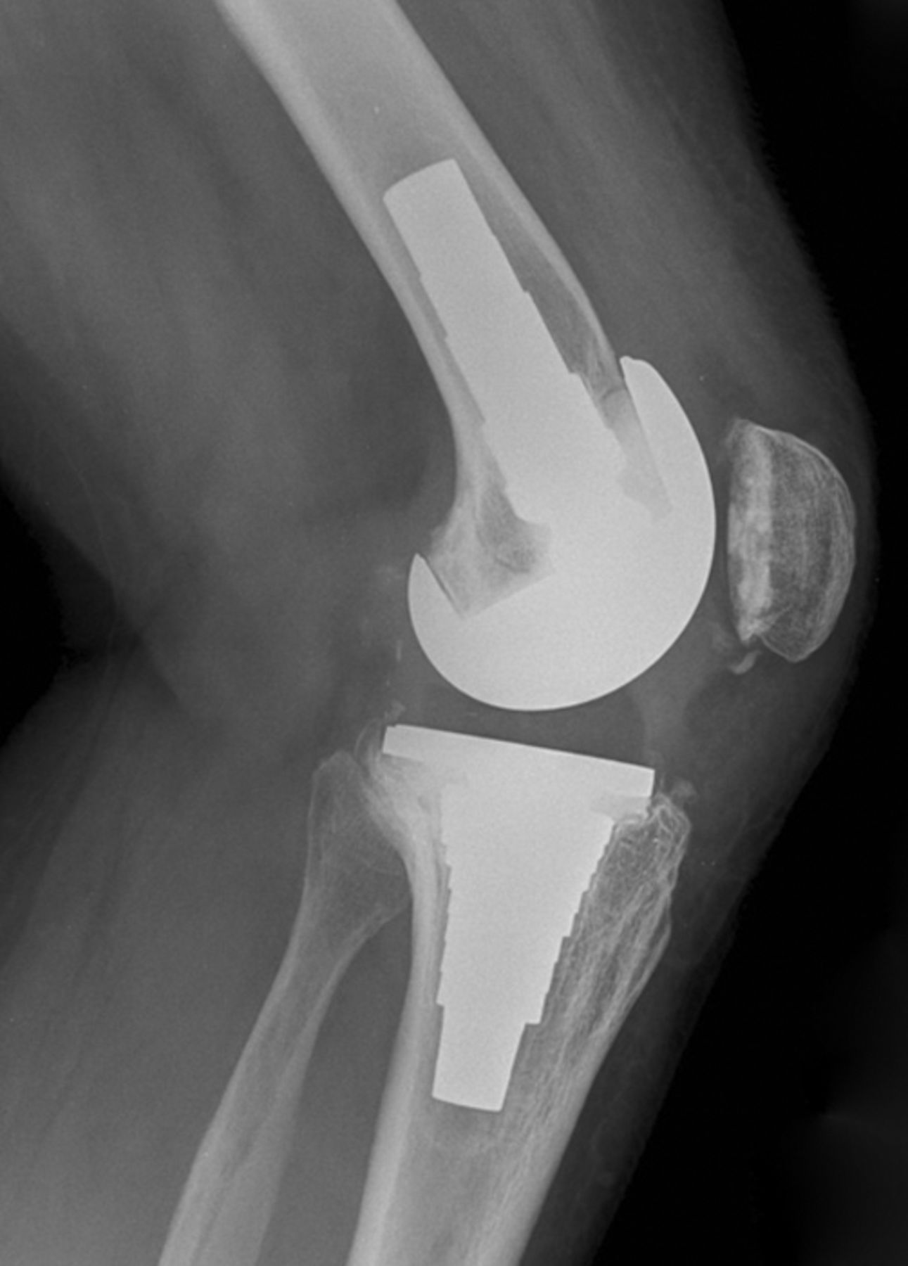 Metal metaphyseal sleeves in revision total knee replacement | Bone & Joint