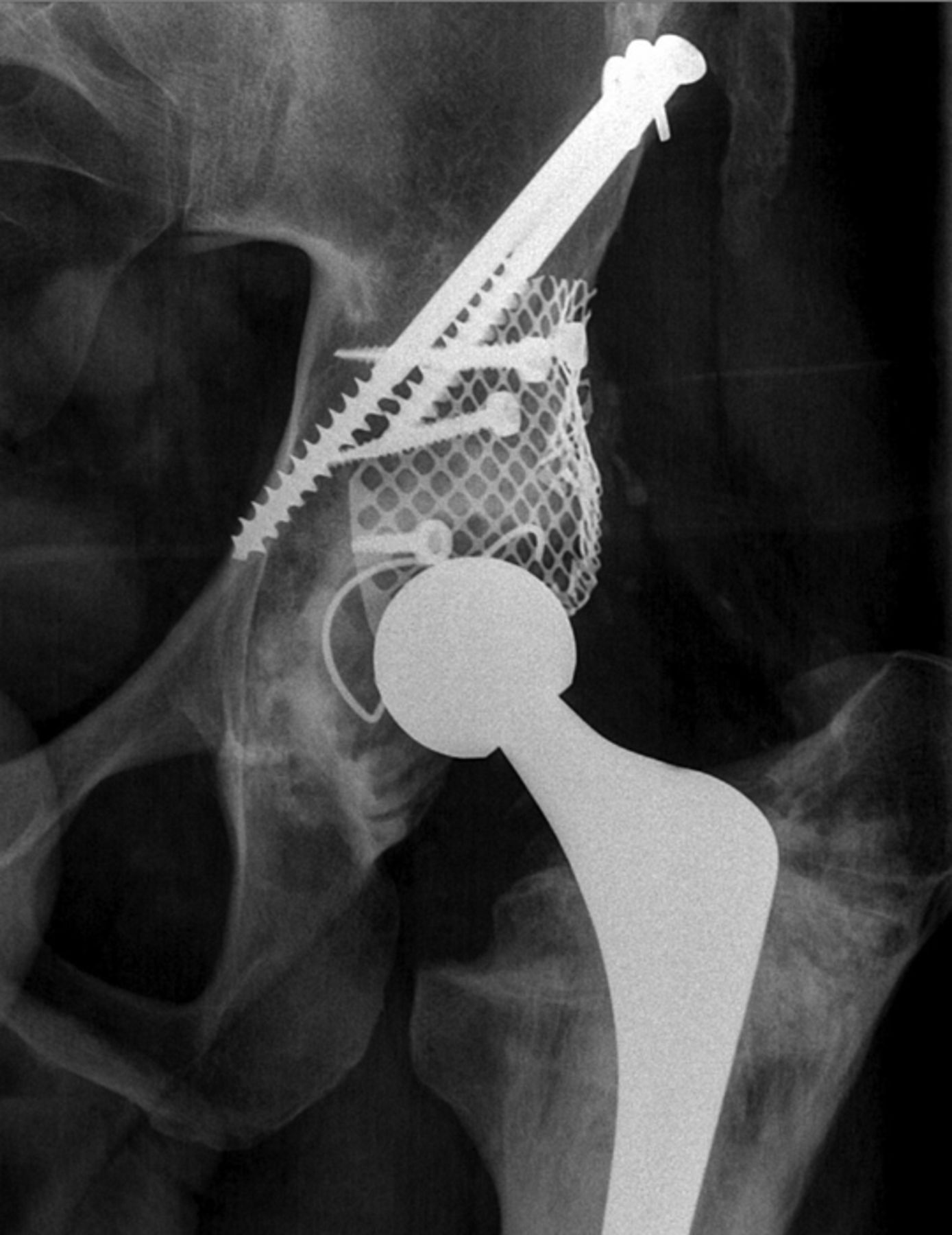 Clinical And Radiological Outcome Of The Cemented Contemporary