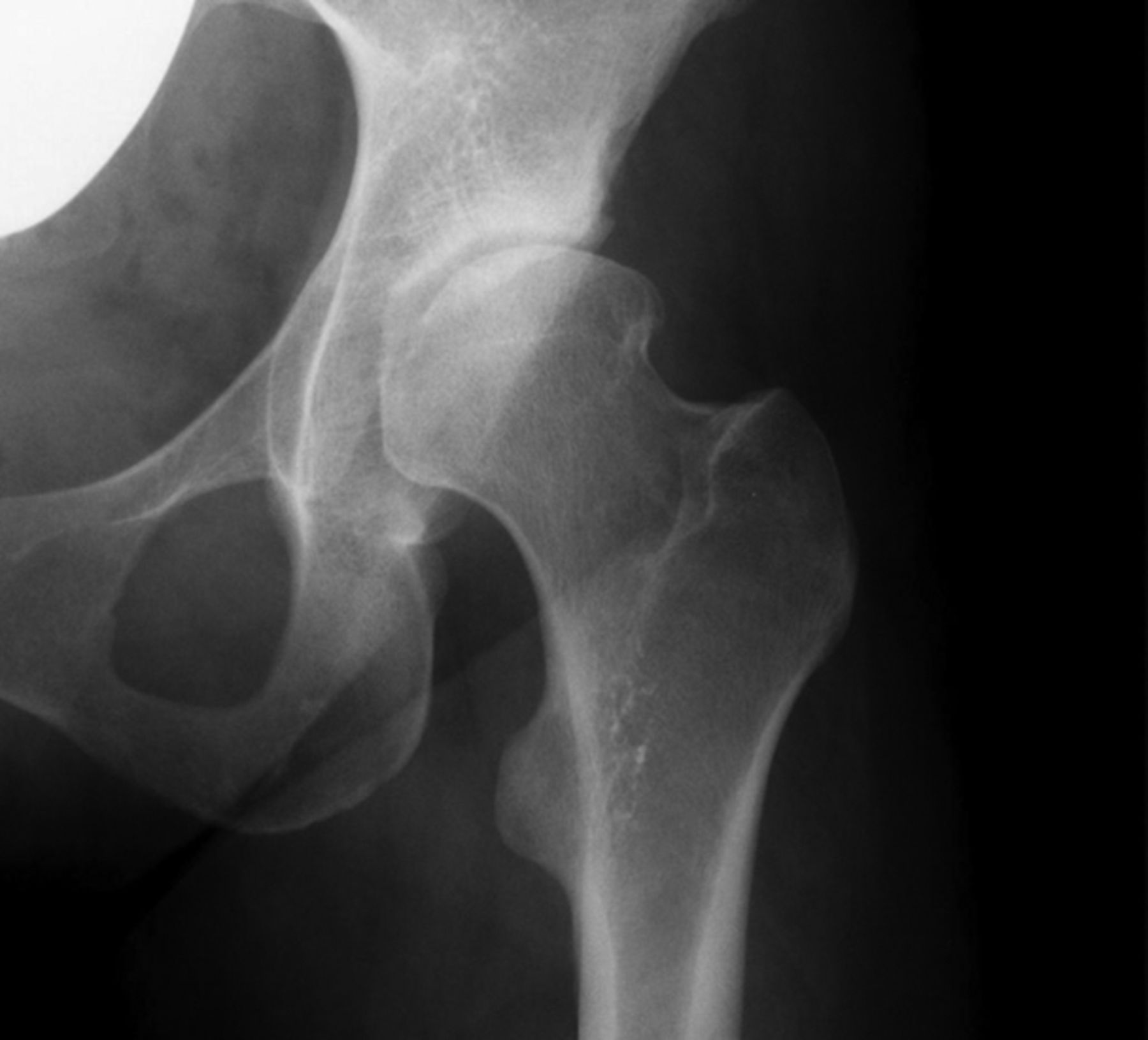 Clinical And Radiological Outcome Of The Cemented Contemporary