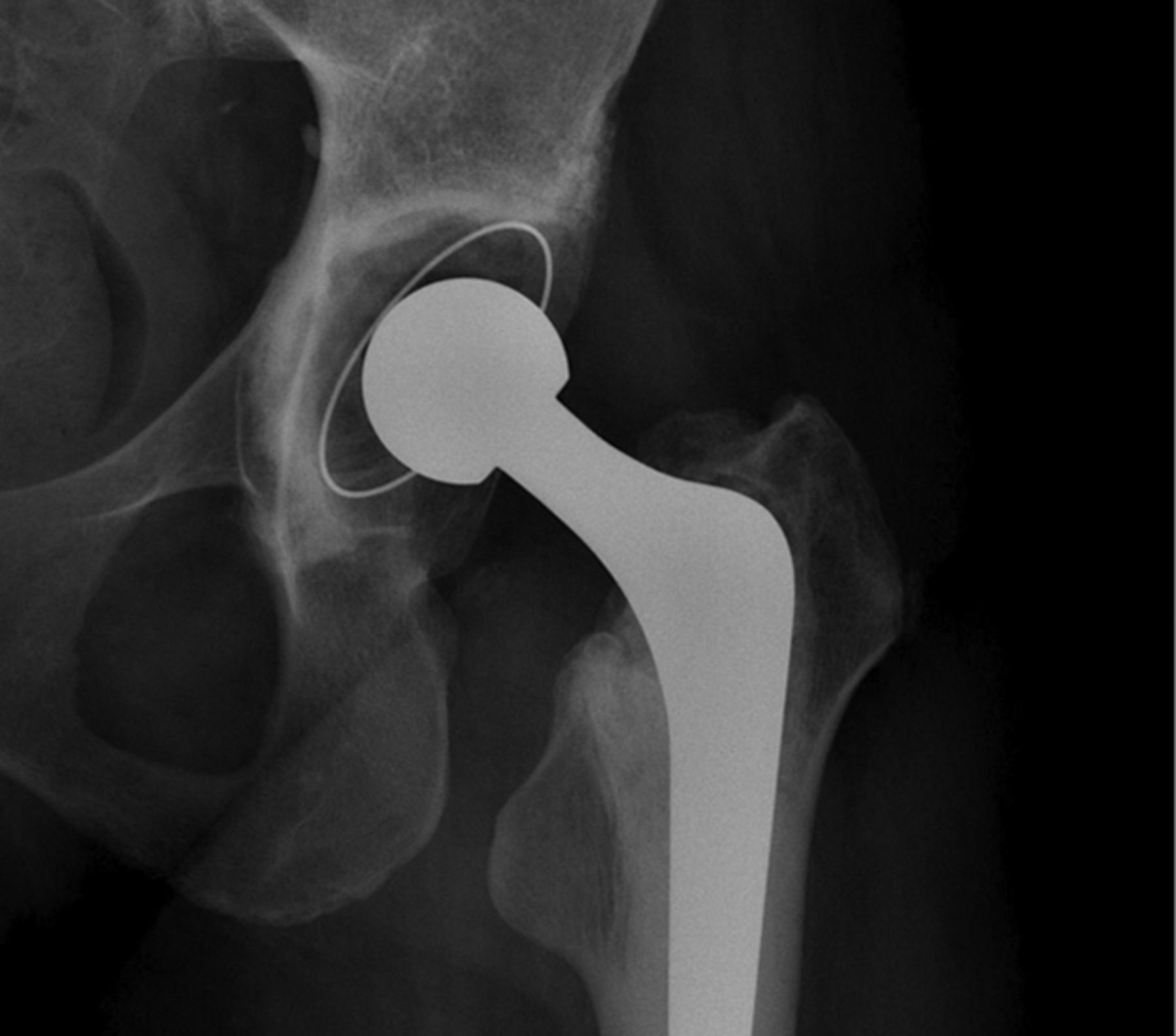 Clinical And Radiological Outcome Of The Cemented Contemporary