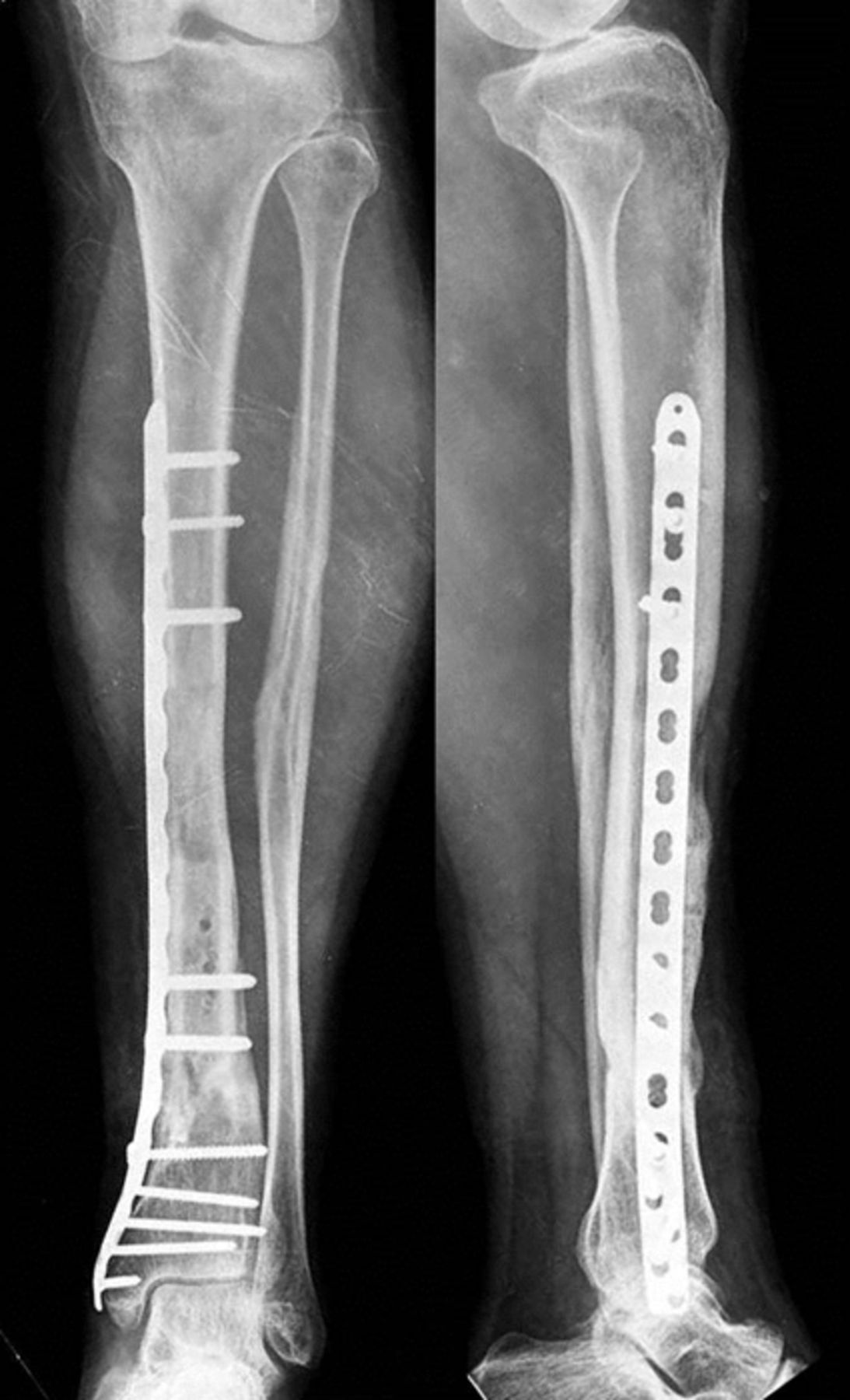 Bone Transport With An External Fixator And A Locking Plate For ...