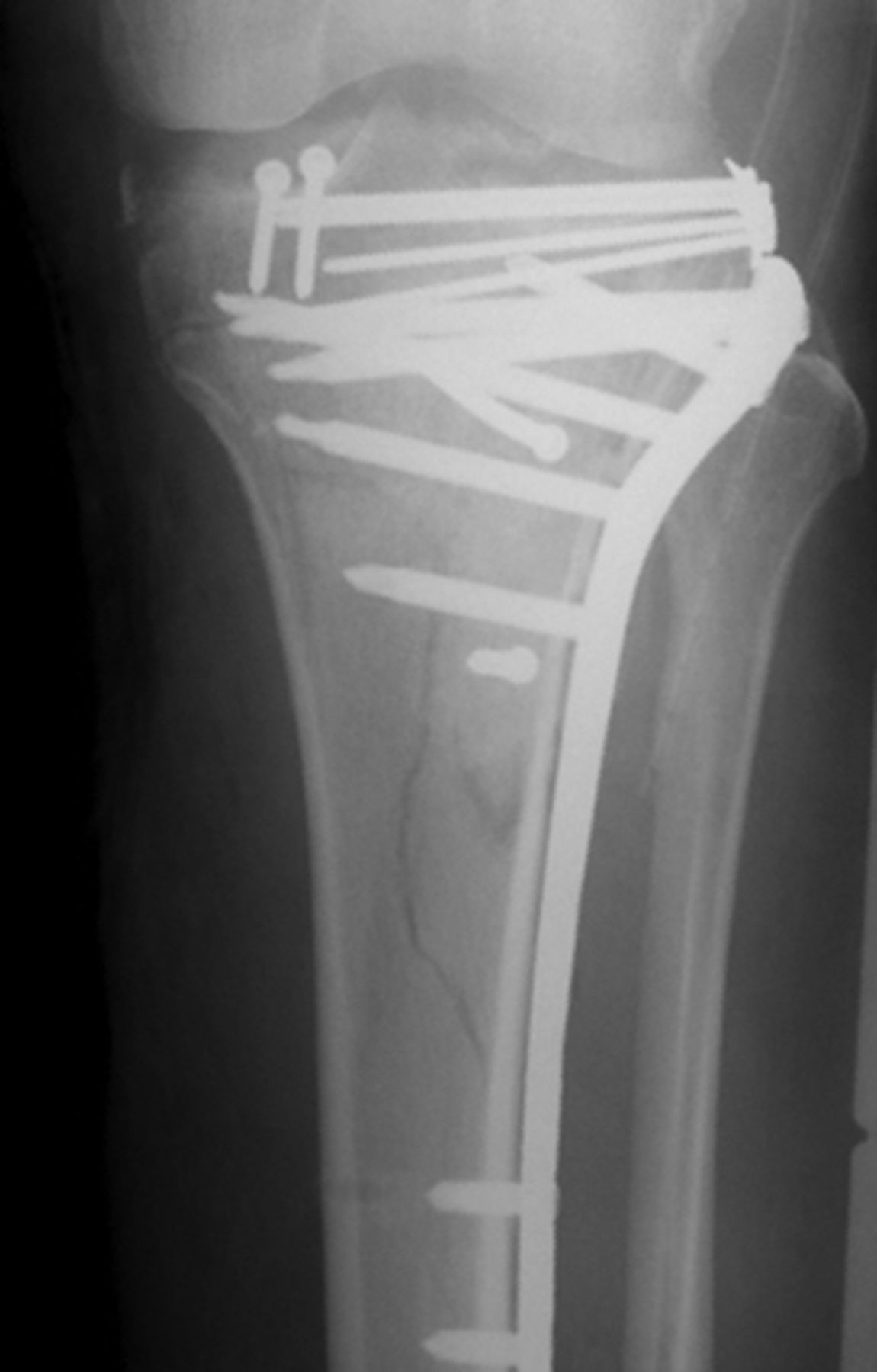 Management And Incidence Of Tibial Tubercle Fractures In Bicondylar ...