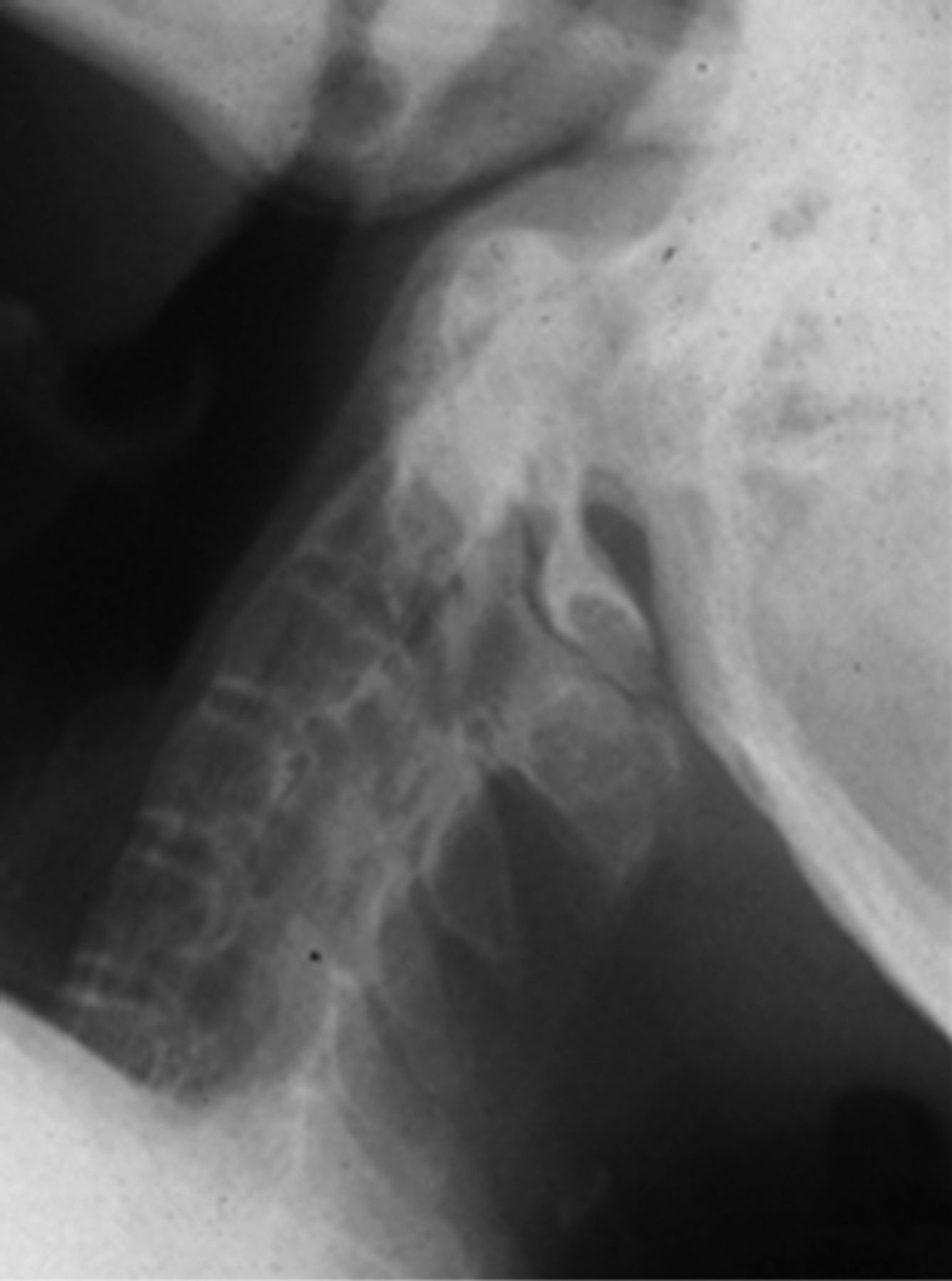 A new mechanism of injury in ankylosing spondylitis | Bone & Joint