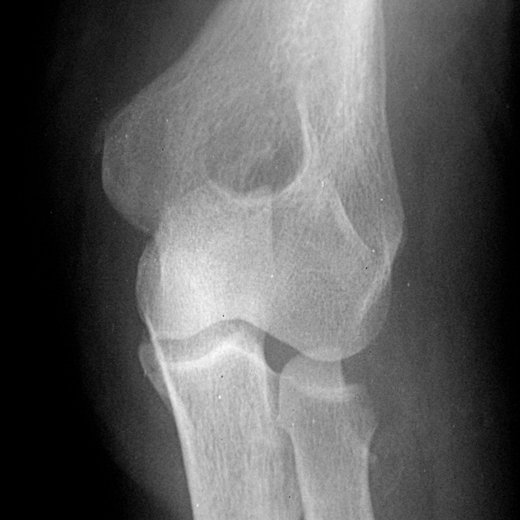 Fractures Of The Radial Head Bone Joint   29877 Galleyfig2 