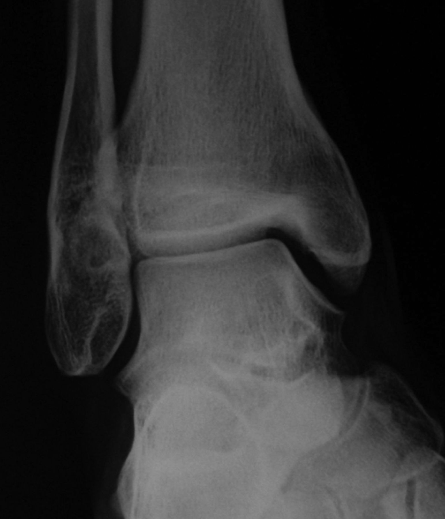 Prognostic factors for premature growth plate arrest as a complication ...