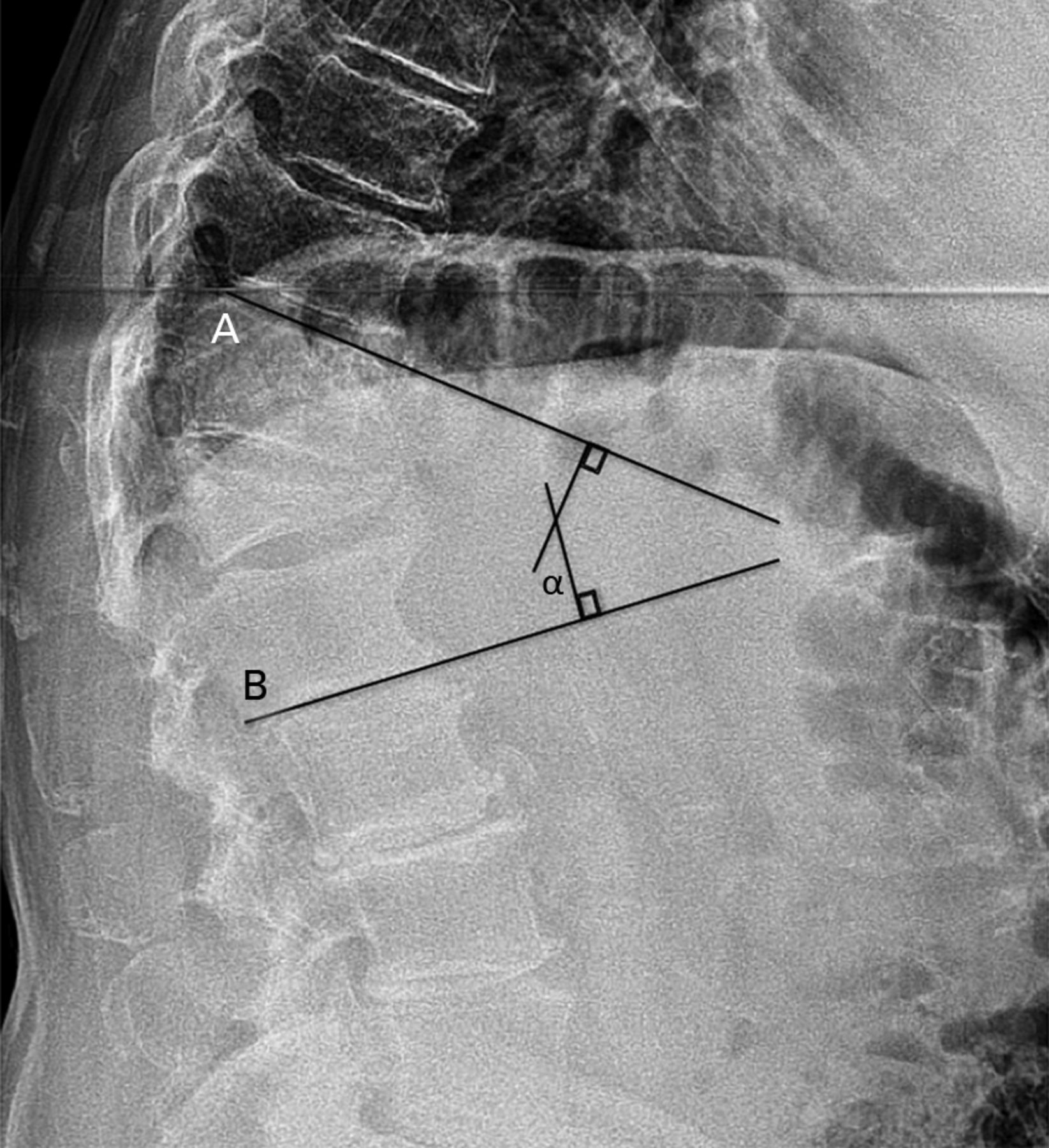 Comparison Of Unipedicular And Bipedicular Balloon Kyphoplasty For The